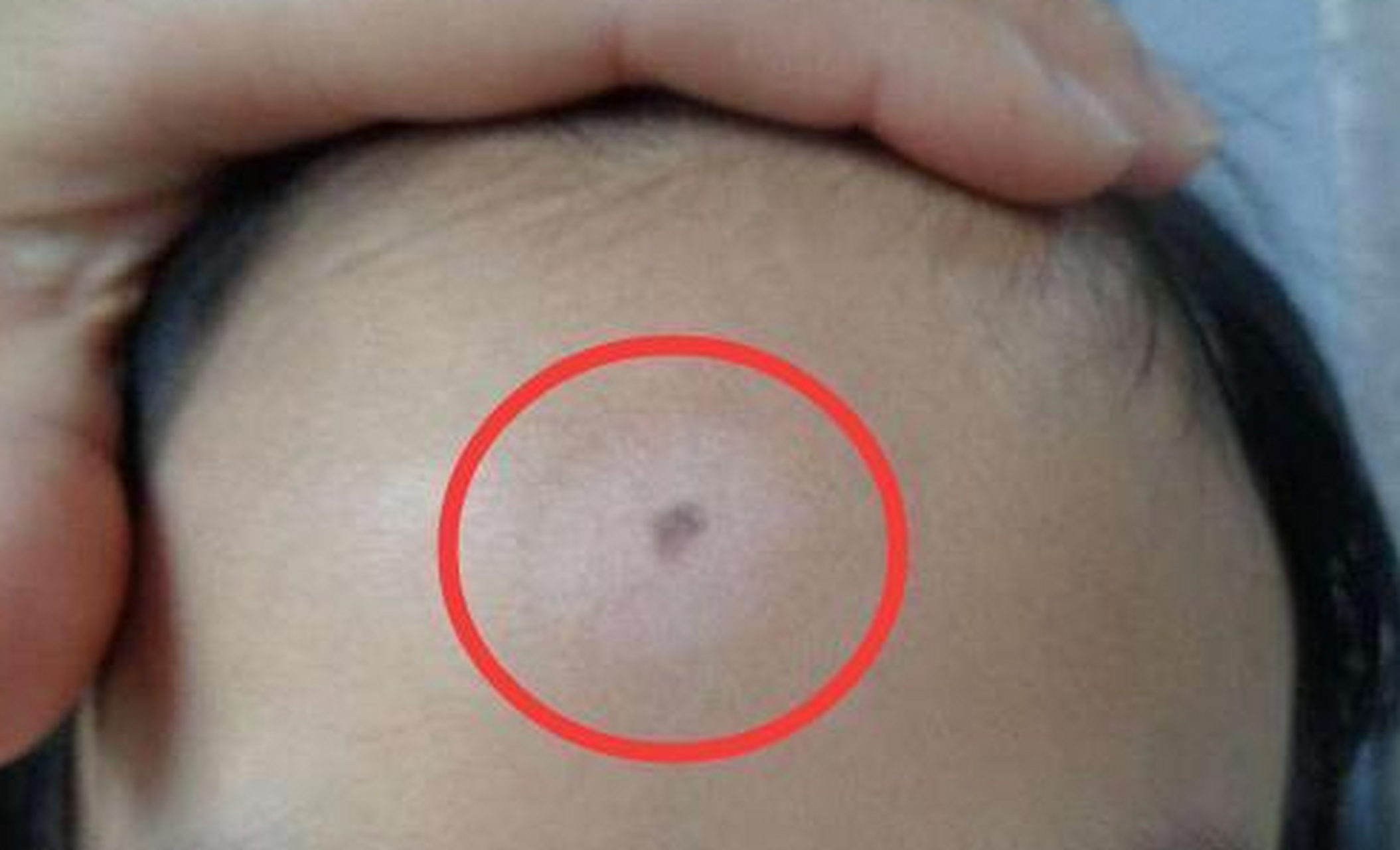 ①晕痣型白癜风的白斑,主要是围绕晕痣周围而出现的色素脱失