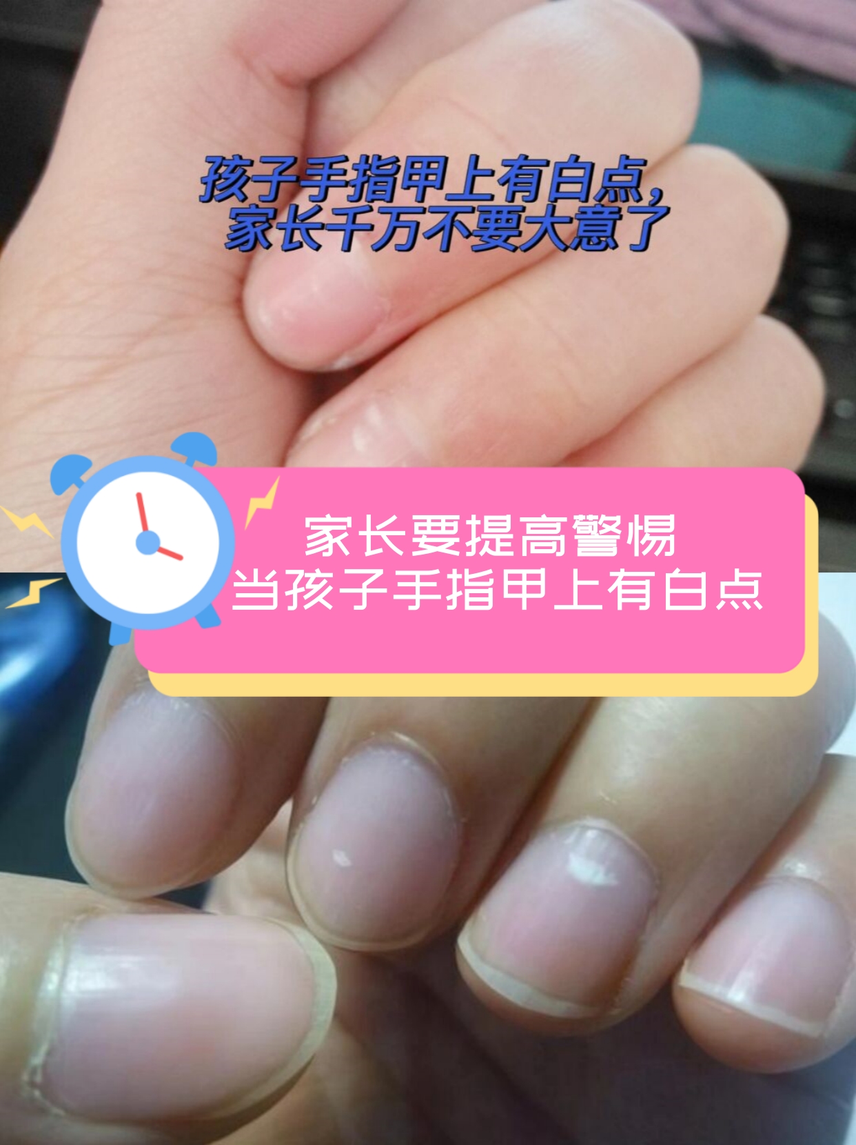 家长要提高警惕 当孩子手指甲上有白点