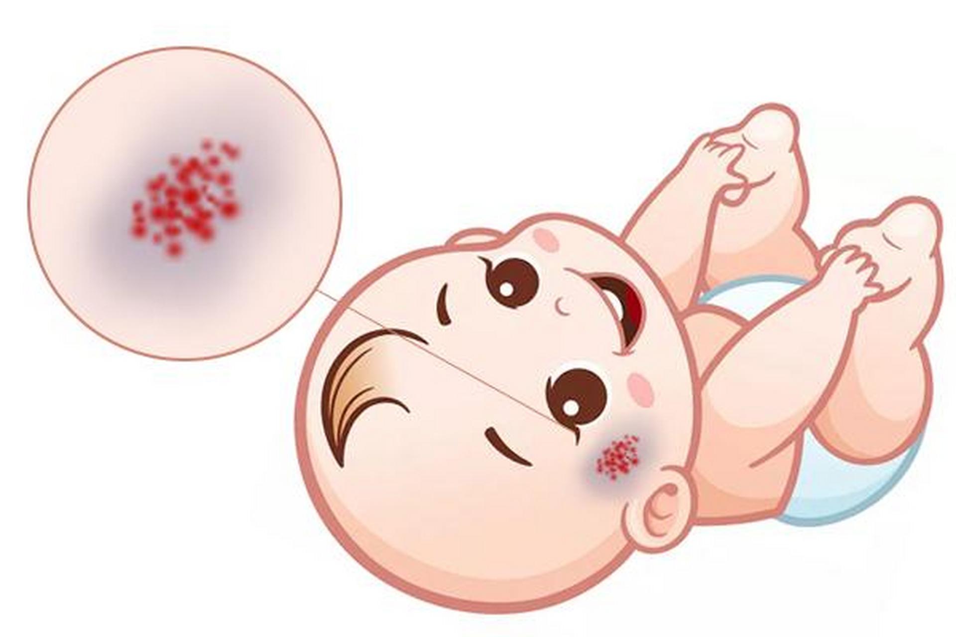 葡萄酒色斑也是一种由膨胀的血管造成皮肤颜色变红或