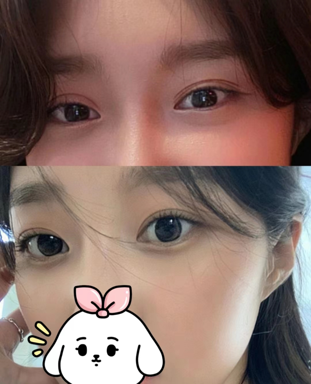 多层双眼皮修复,从大妈变韩妹!