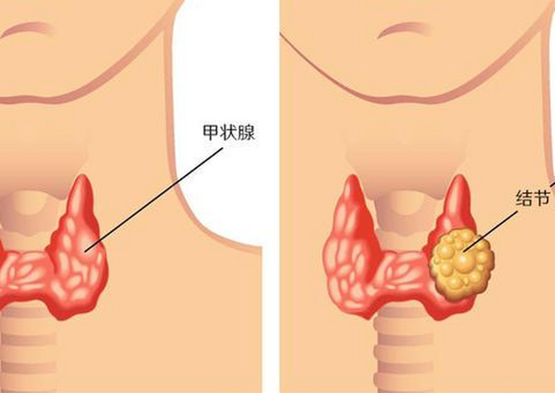 甲状腺腺瘤和结节区别    甲状腺腺瘤跟结节只是称谓不一样,结节