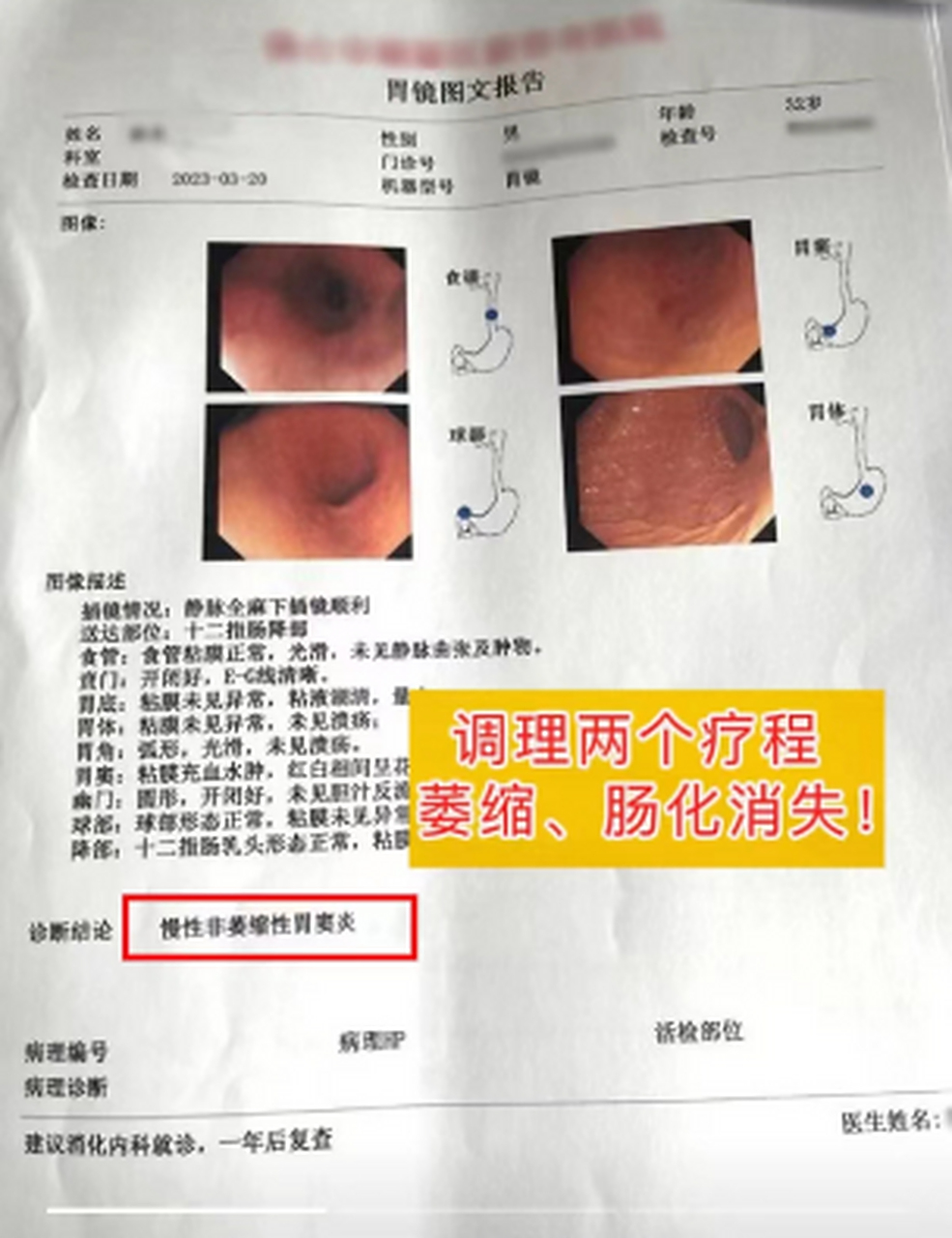 萎缩性胃炎患者,王先生,32岁,因频繁出现胃胀,胃痛进行胃镜检查,胃镜