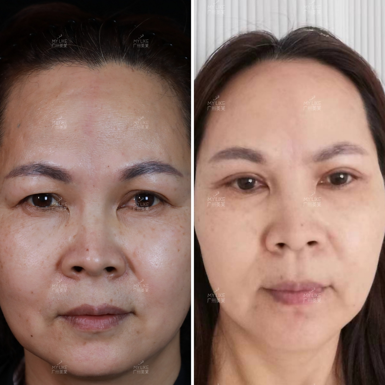 上眼皮松弛下垂,50岁如何不垮眼?