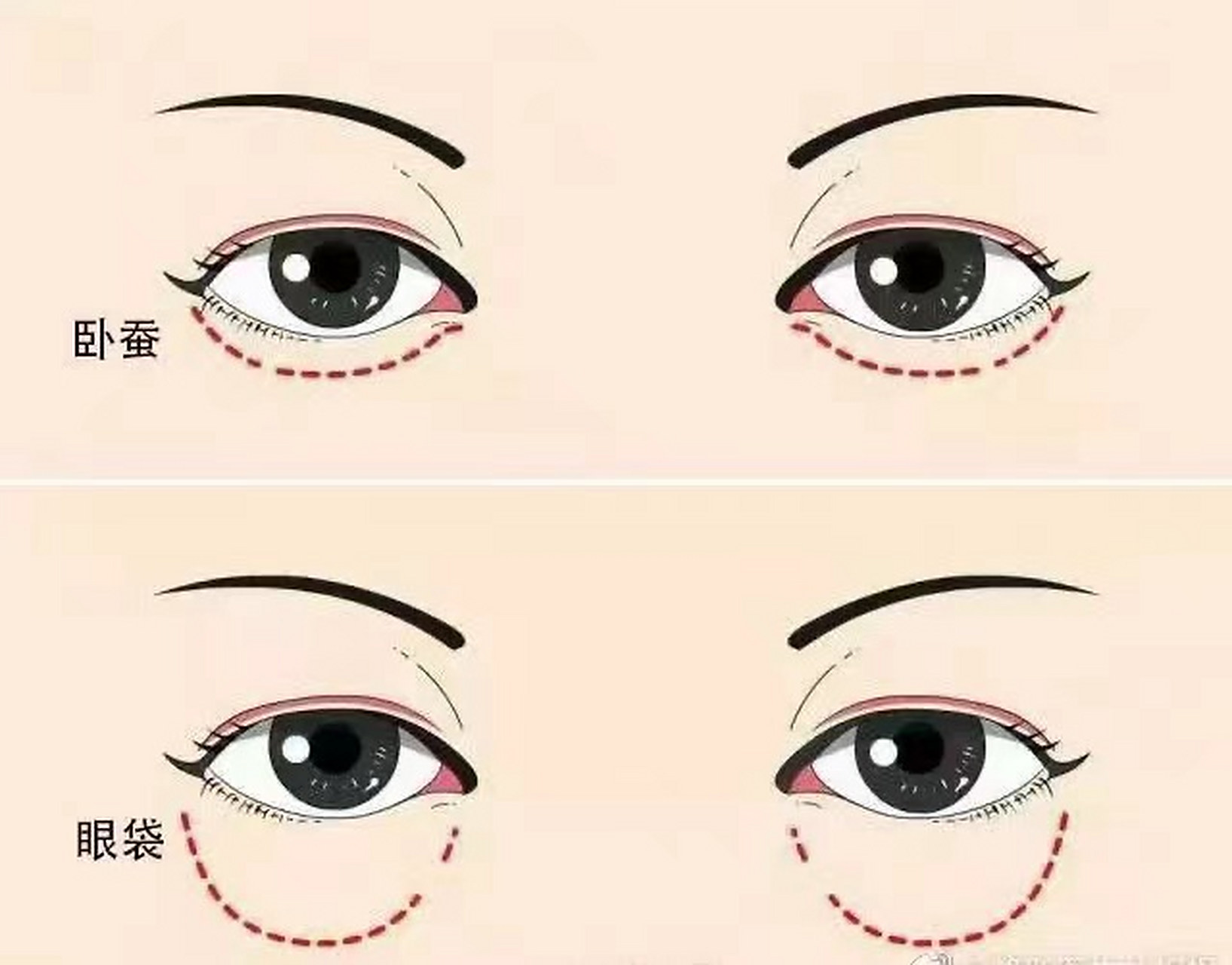 面诊中经常有顾客问,眼袋和卧蚕到底有什么区别?  眼袋和卧蚕的位置虽