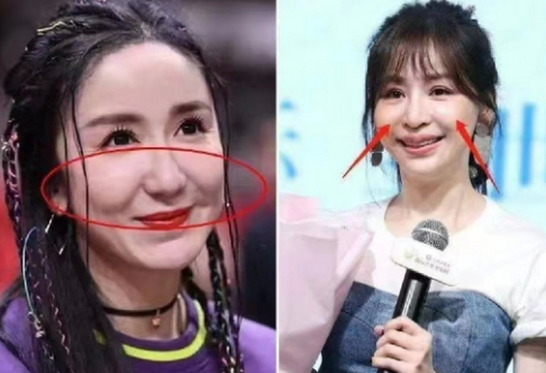 第一原因:过度填充苹果肌.