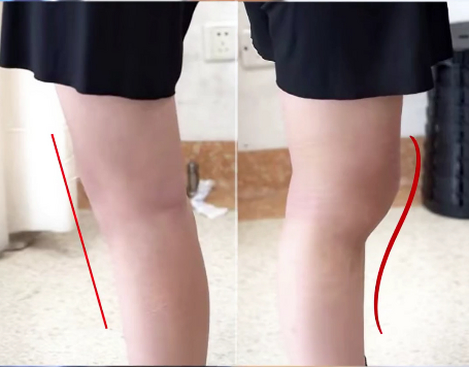 是,但不是简单的膝外翻.