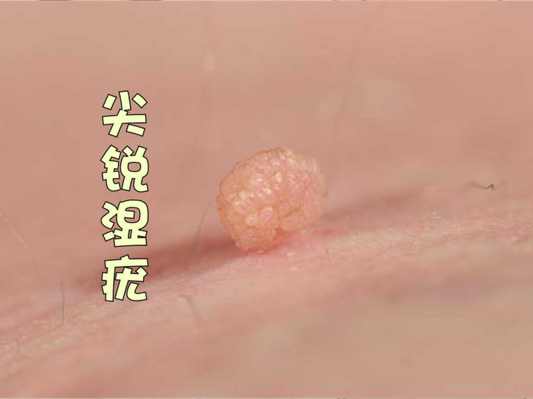 男性尖锐湿疣早期,能察觉到哪些症状?