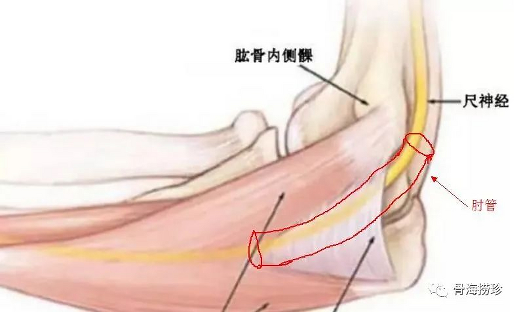 尺神经松解术是一种针对尺神经受压导致的手腕和手部疼痛,麻木和肌肉