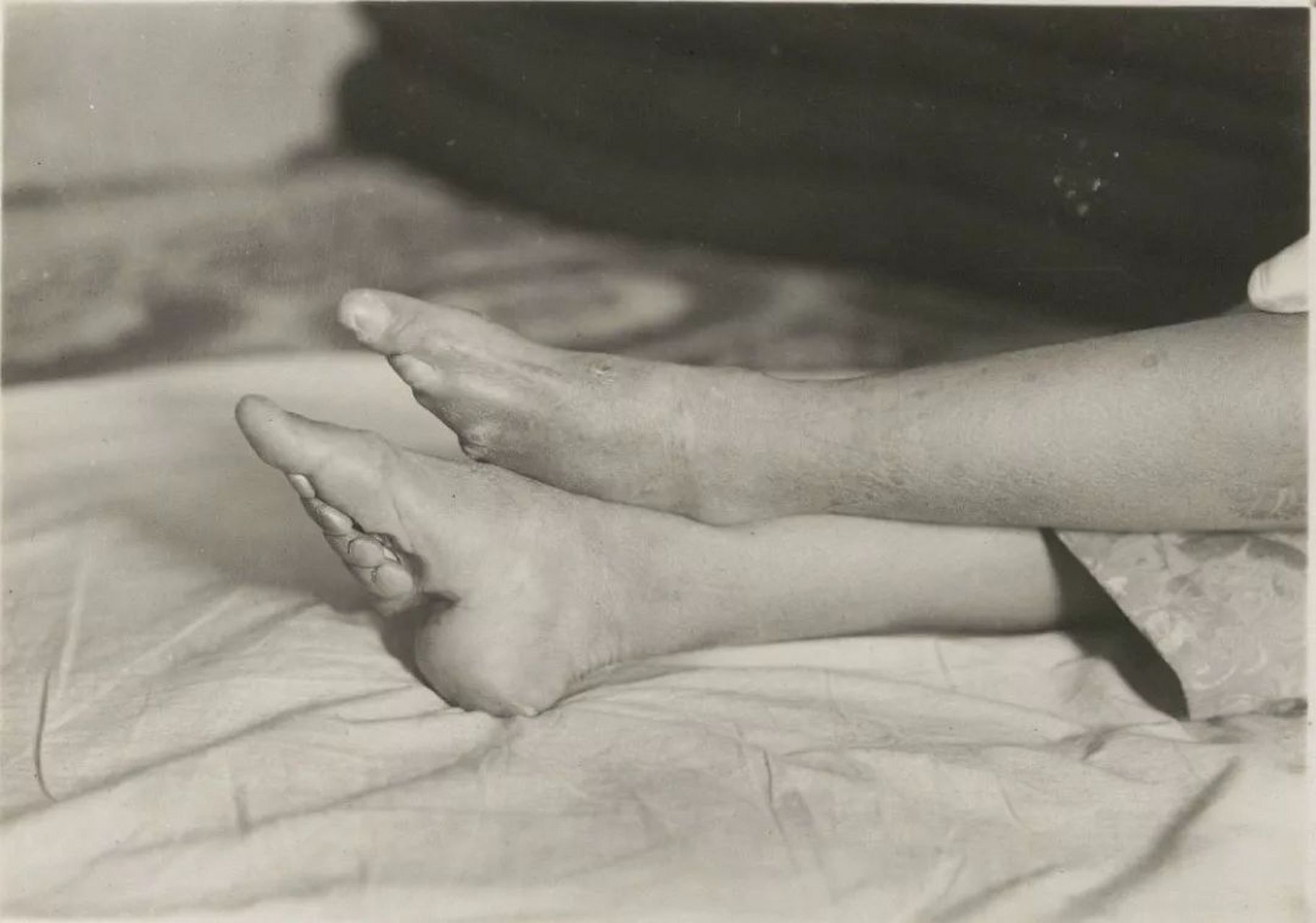 清朝年间,一名缠足的女子坐在自己的卧床上,解开层层的裹脚布透气