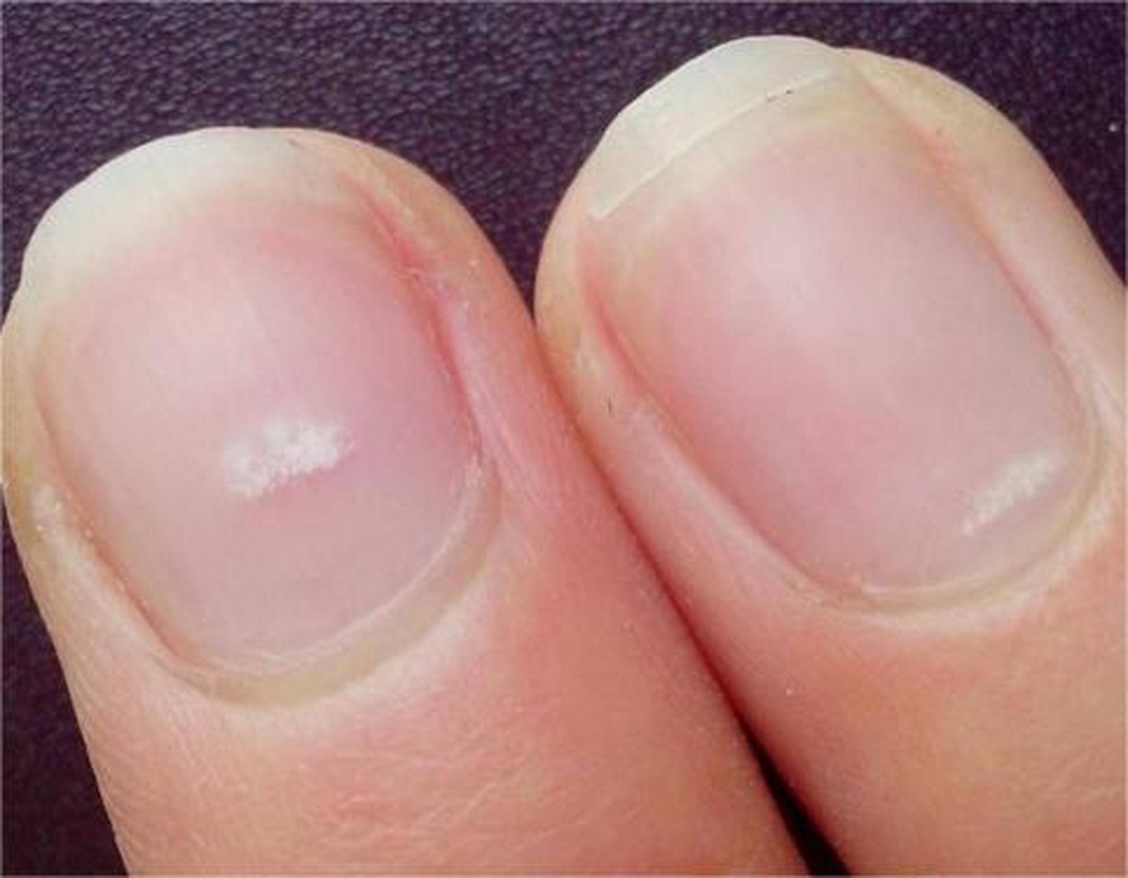 指甲上突然出现一块白斑是怎么回事?