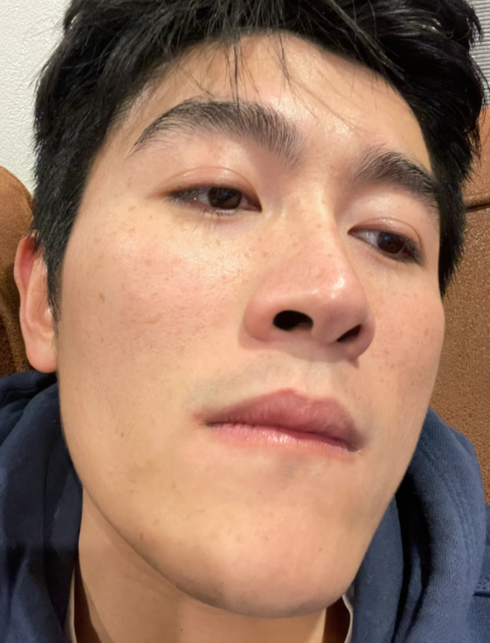 那么,男人脸上长黄褐斑怎么治疗呢?