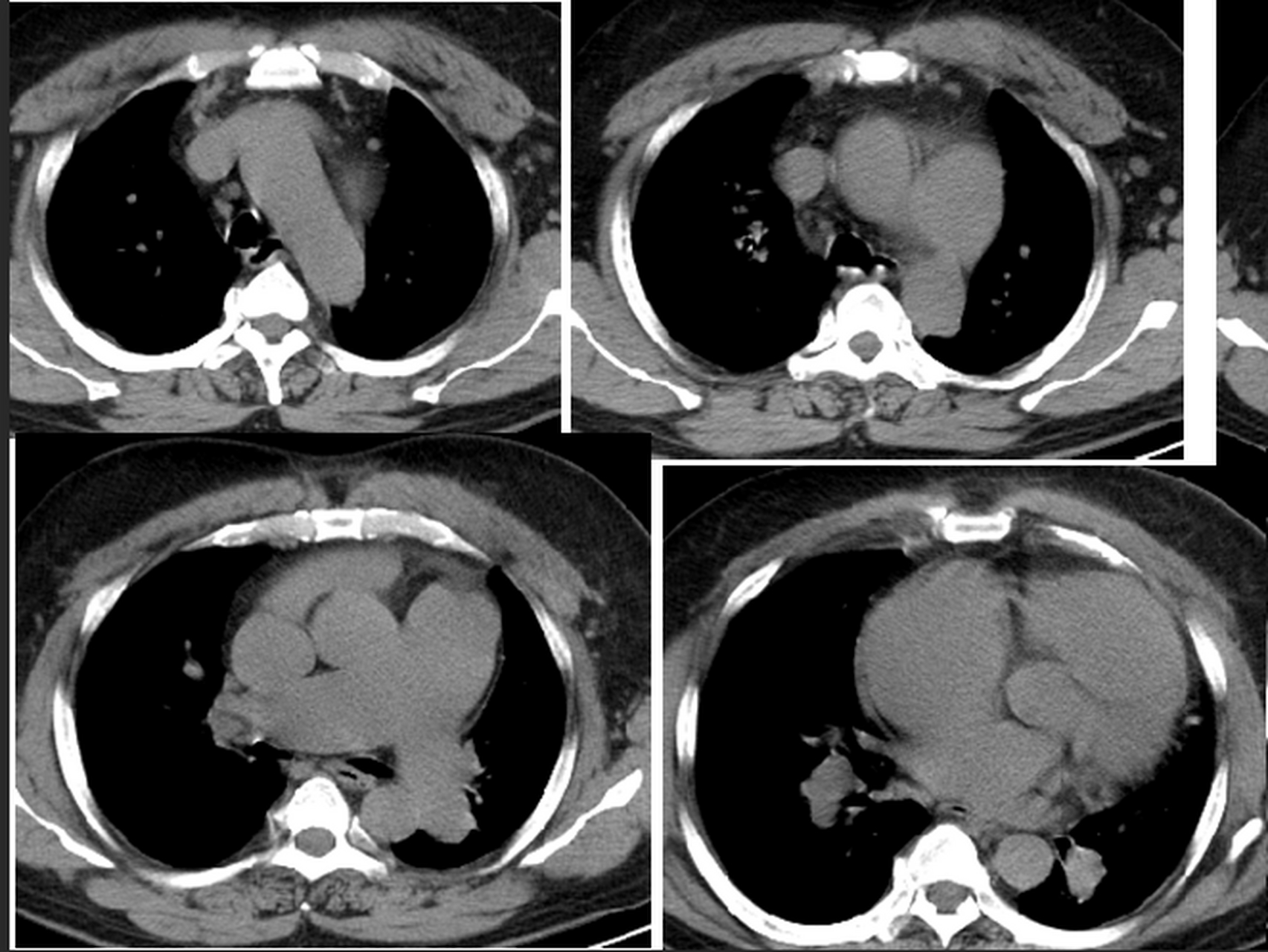 1,肺部ct 在ct上可看到肺脏的表现,如两肺的支气管扩张,胸廓畸形