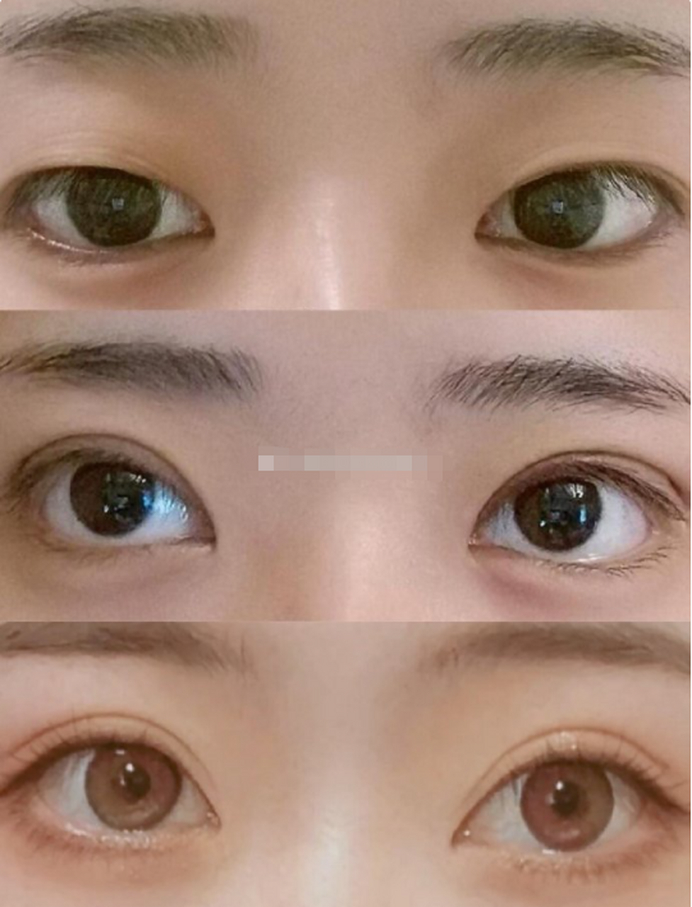 想象一下,开扇形双眼皮手术的简单步骤,就能毫无限制地放大眼睛,还有