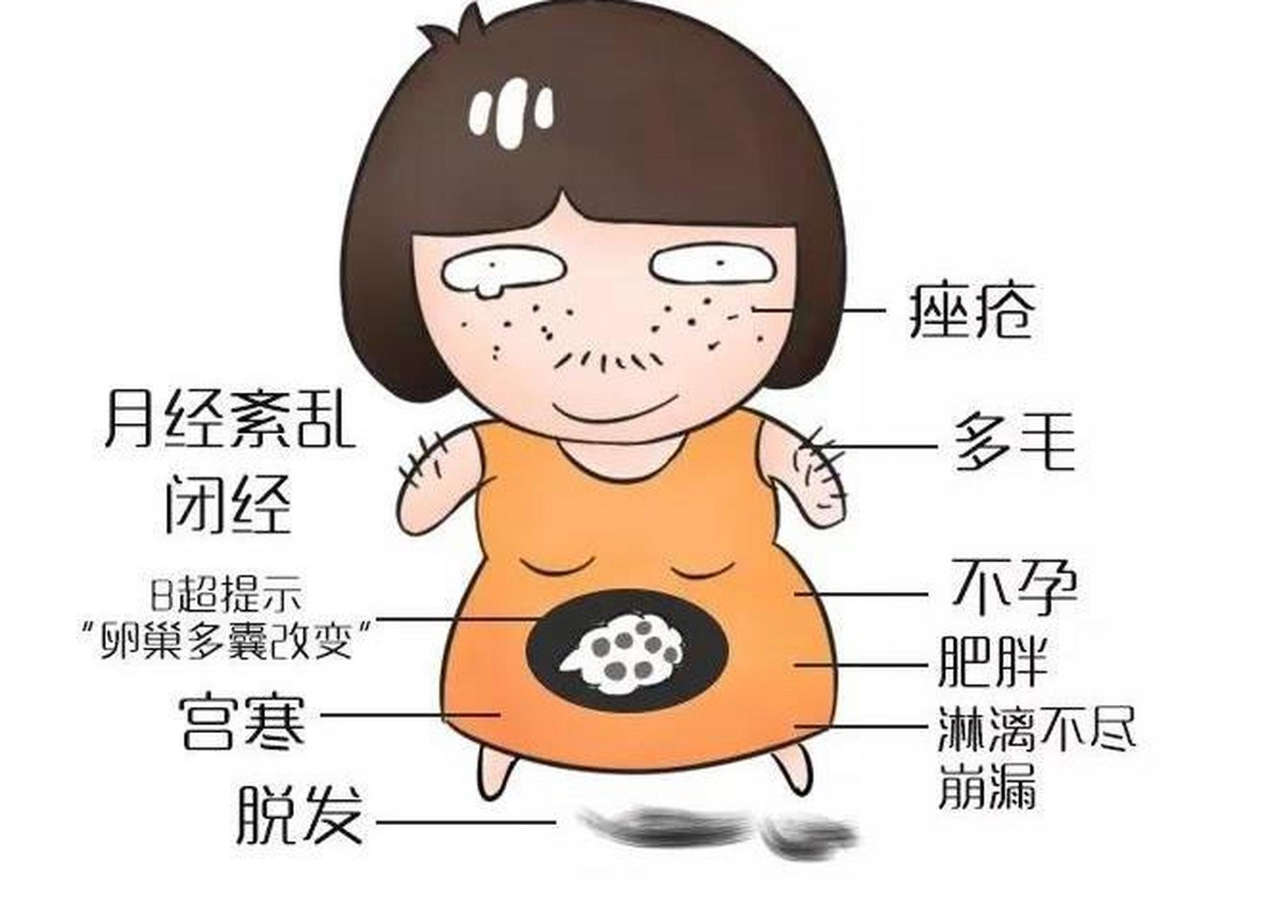 多囊卵巢综合征的症状有哪些?