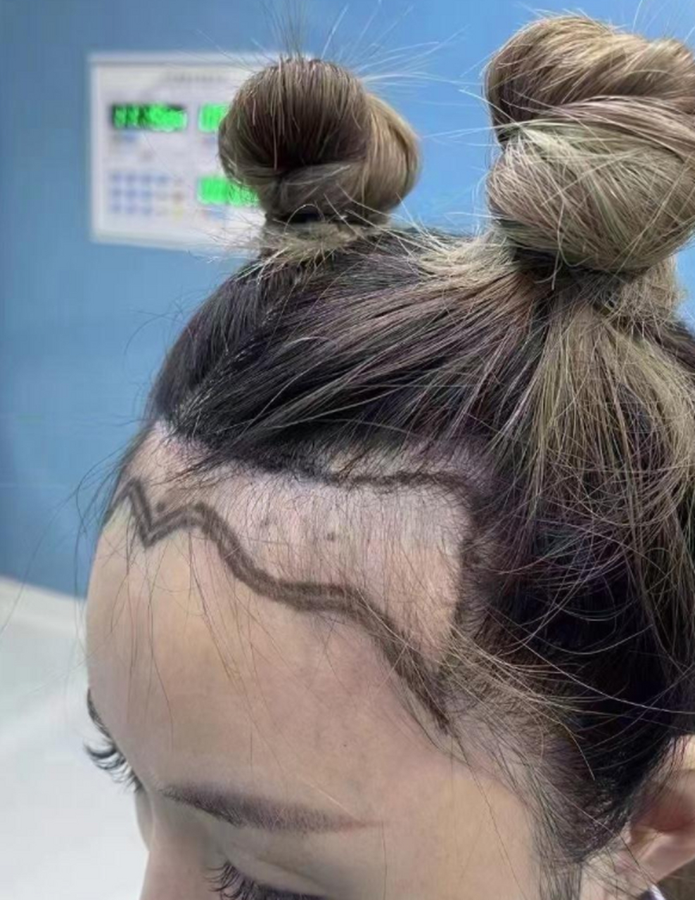 发际线后移是很多人的烦恼,今天就来分享一下发际线后移怎么恢复的