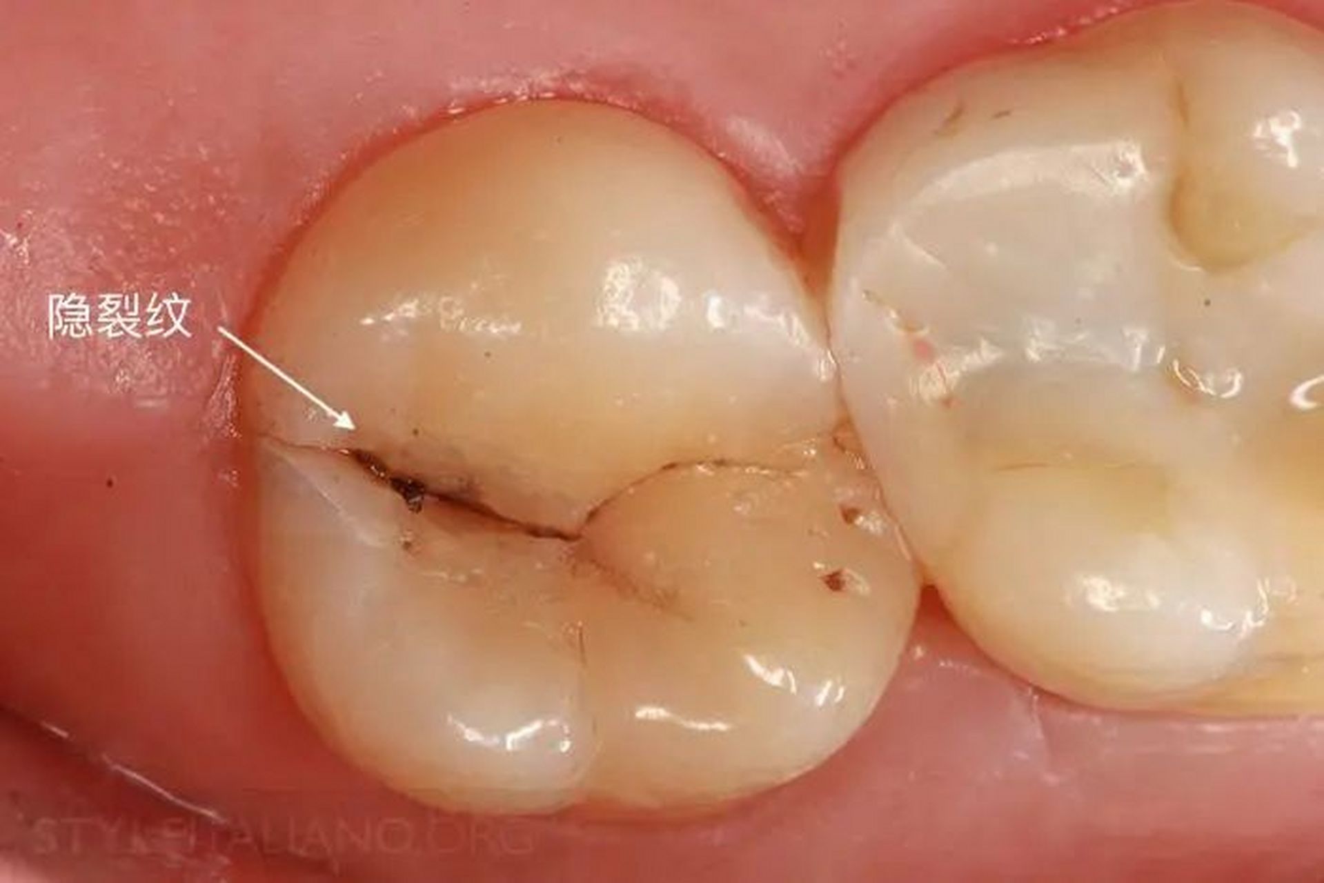 【牙隐裂怎么办?还能修复吗 牙齿作为消化系统的第一道关卡.