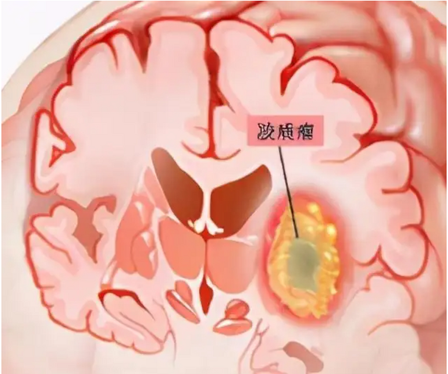 胶质瘤是良性的还是恶性的?