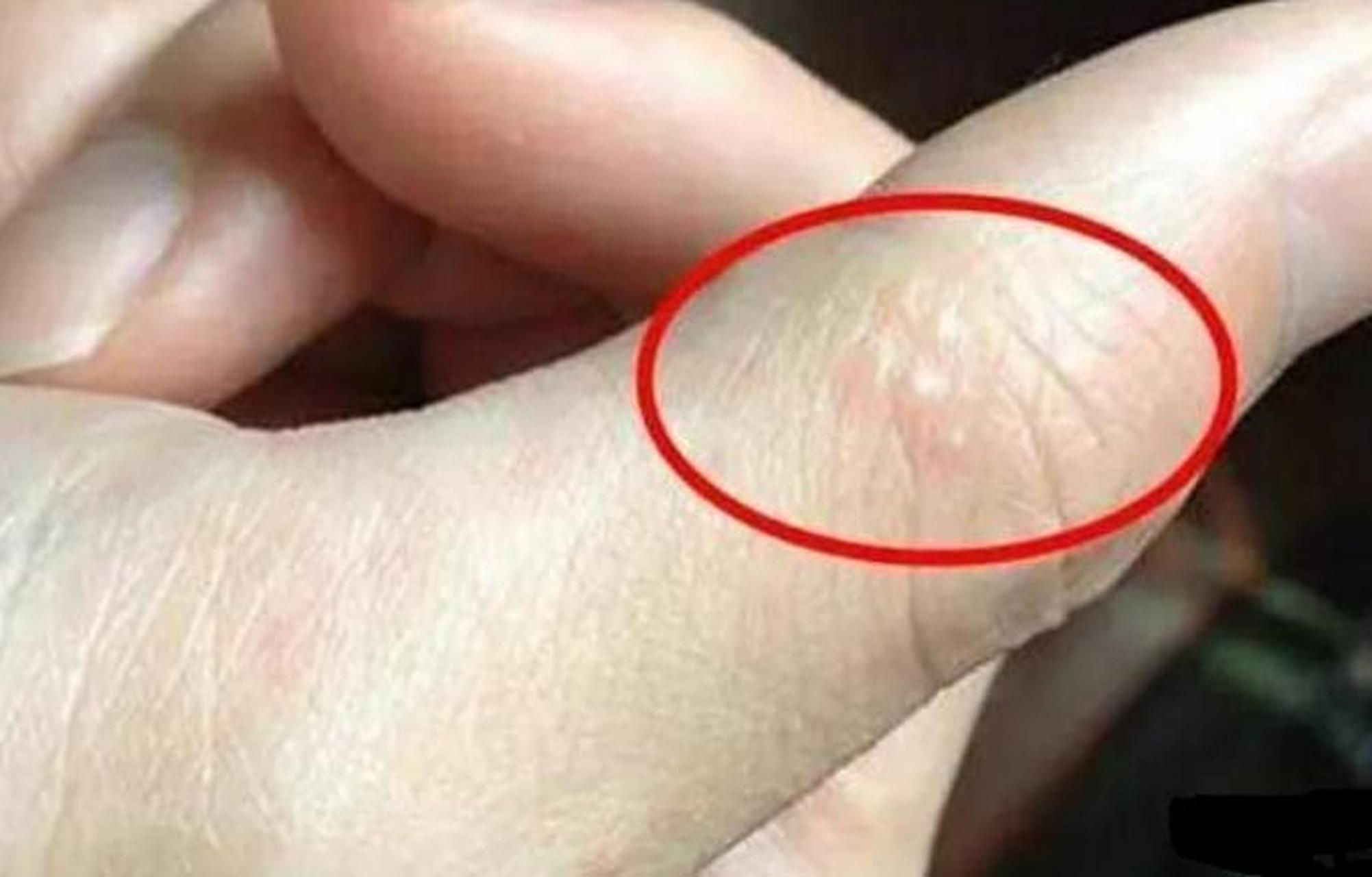 夏天一到,手上就开始长很多透明"小水泡"?