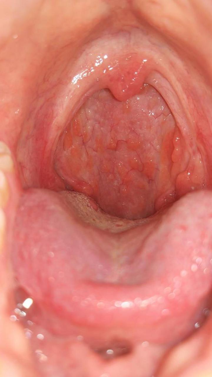 你有没有淋巴滤泡增生,出现喉咙异物感,总感觉嗓子有痰,咳不出咽不下