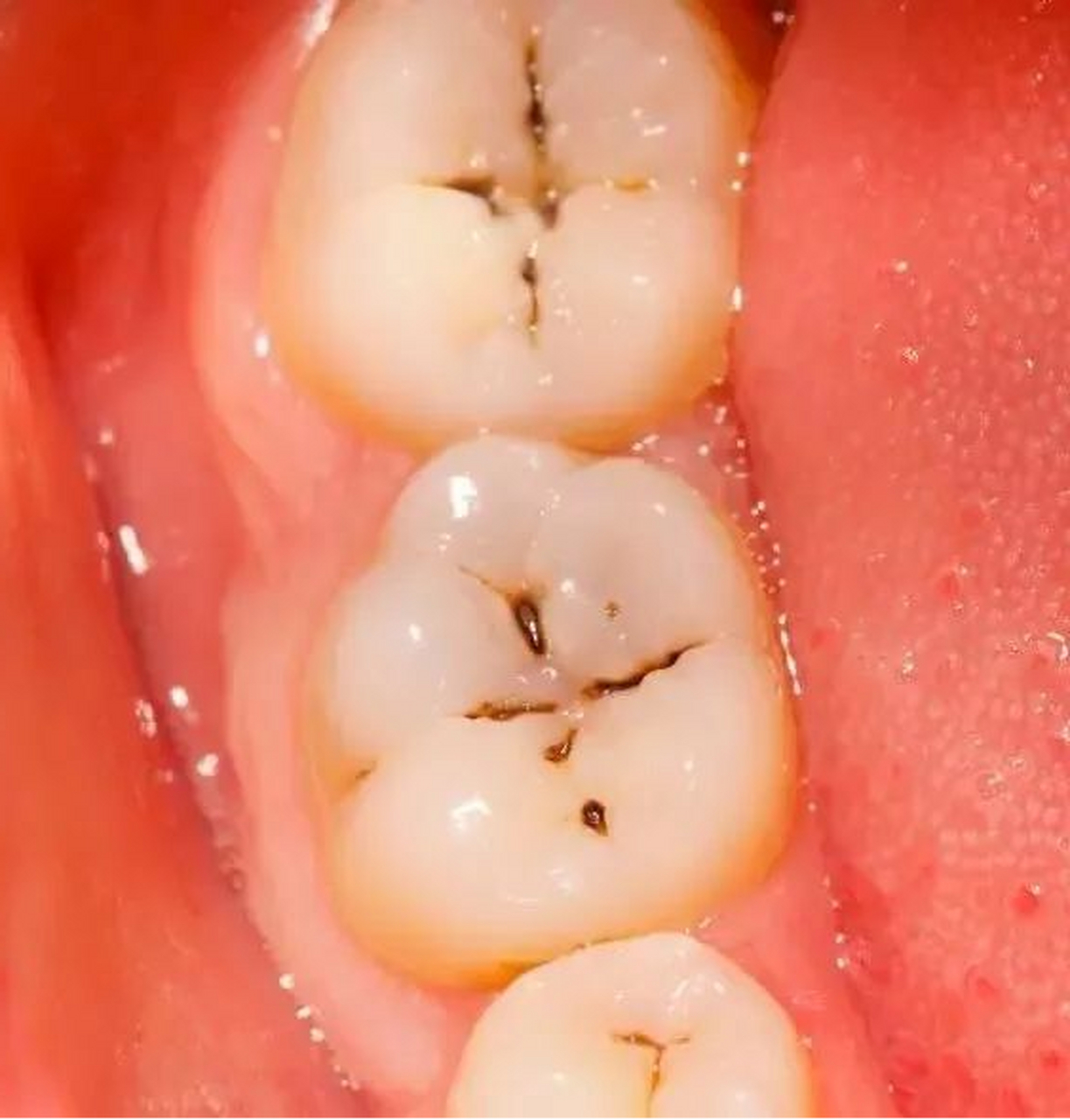 当心,牙齿上的小黑点,可能是吞钱的无底洞 牙齿上的小黑点到底是什么