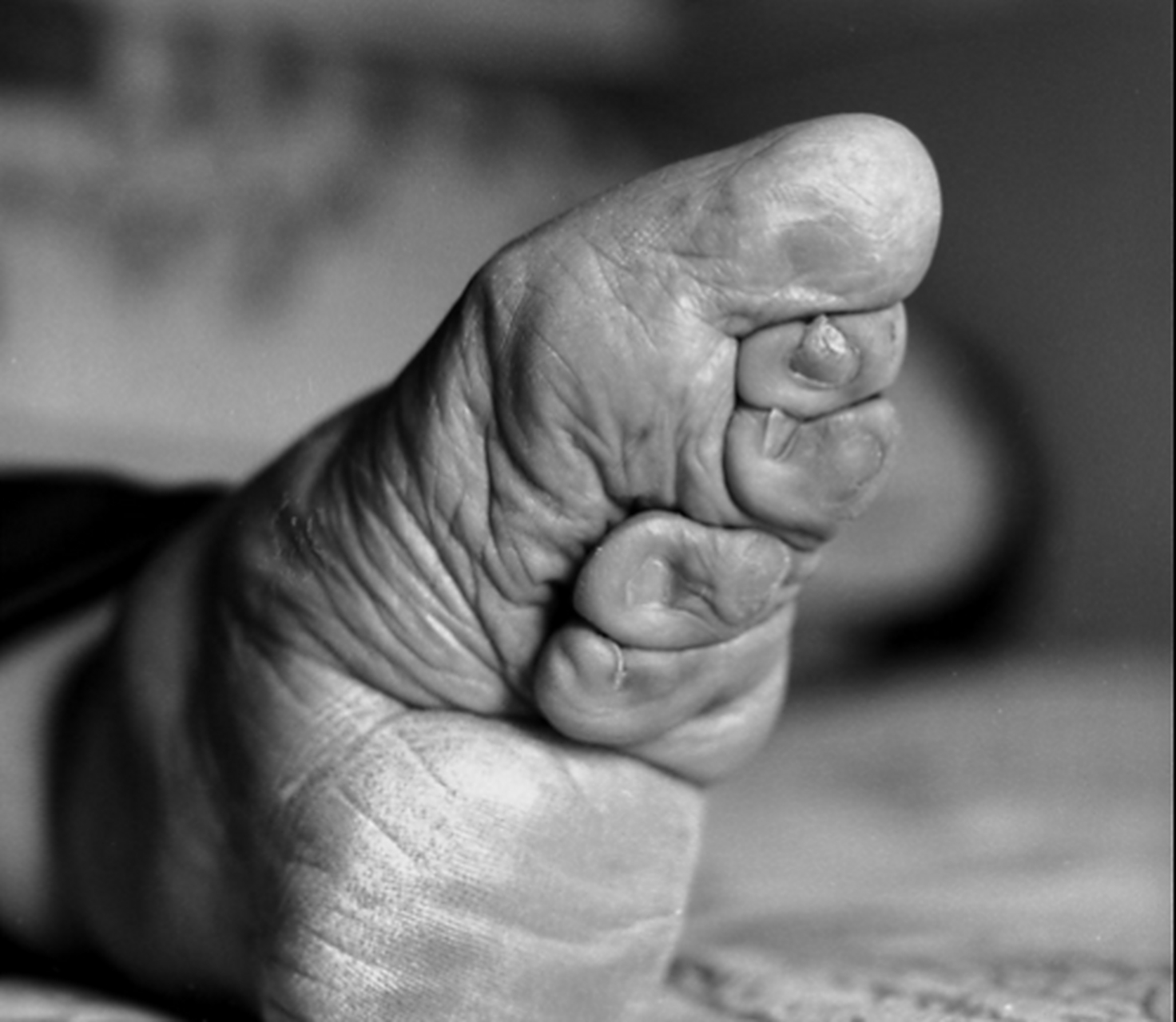 缠足是中国古代一种陋习.  是用布将女性双脚紧紧缠裹,使之畸形变小.