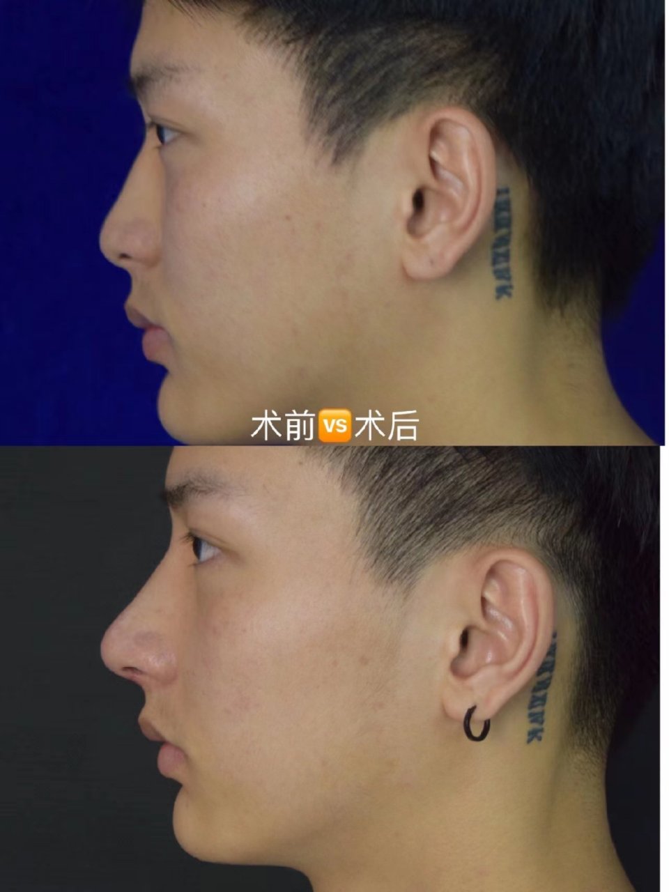 男性隆鼻指南!怎样才能好看又自然? 1.