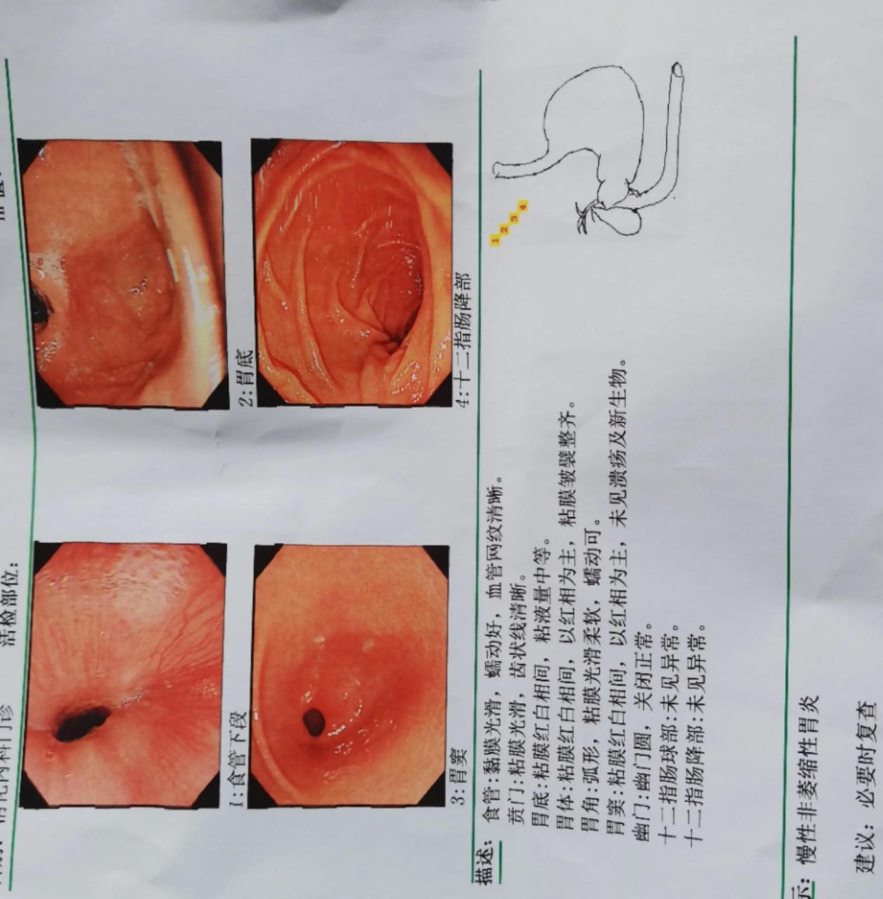 慢性萎缩性胃炎c2图片