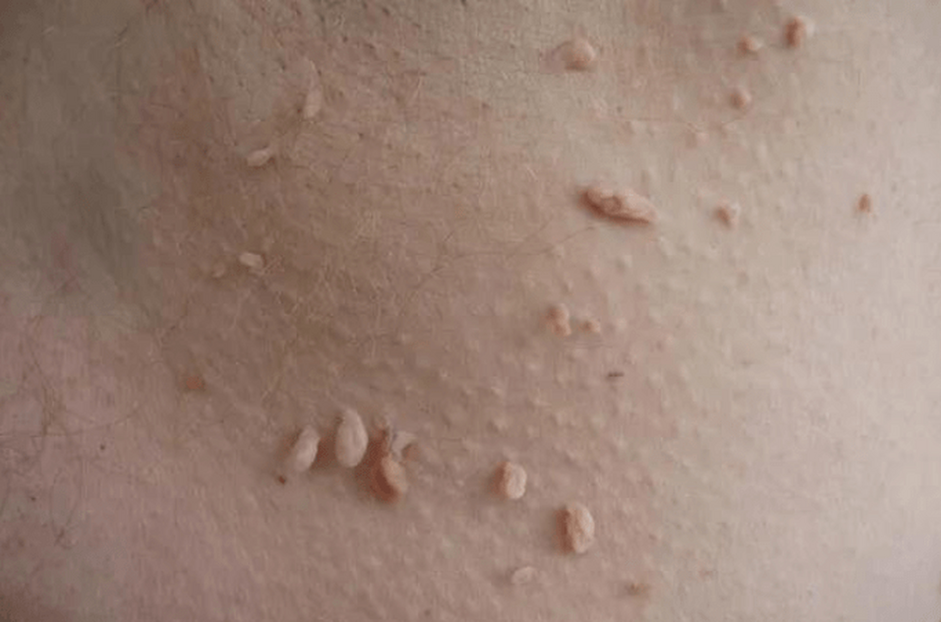 男朋友好像有hpv,怎么办呀 02前几天和男朋友一起洗澡的时候,看见他