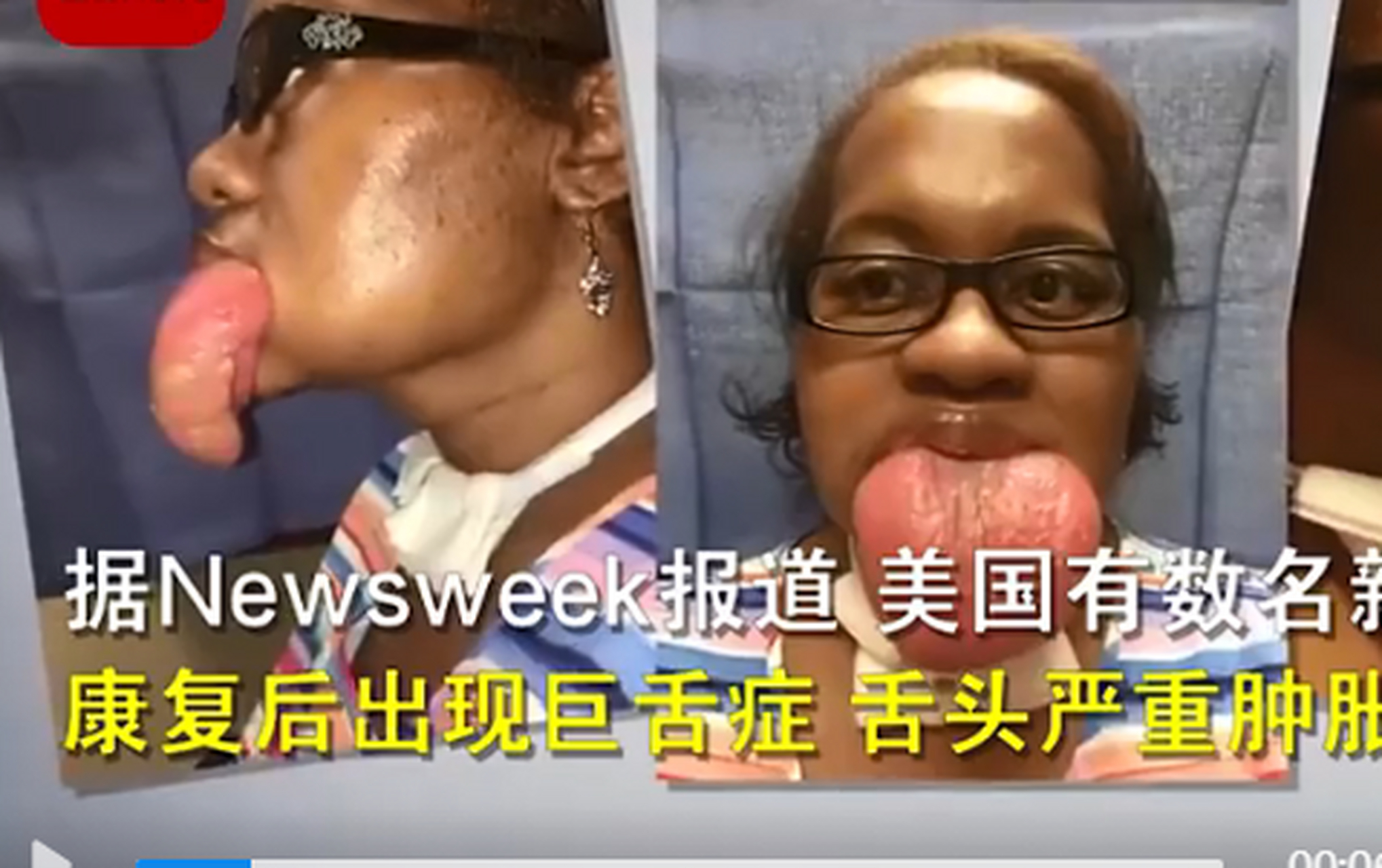 美国多名新冠康复者出现"巨舌症,舌头伸出嘴外约8厘米,无法进食和