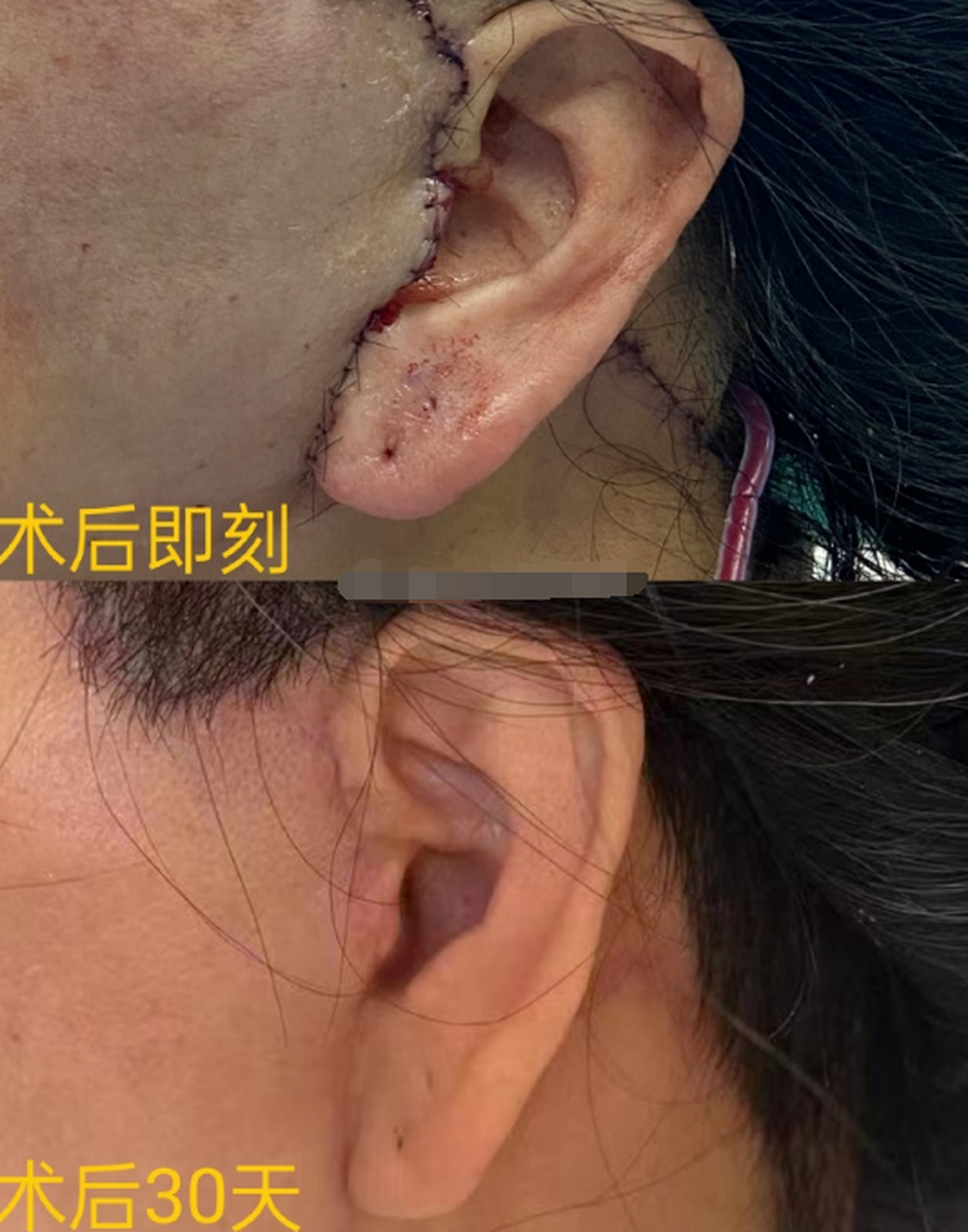 拉皮# 手术切口恢复需要多长时间?