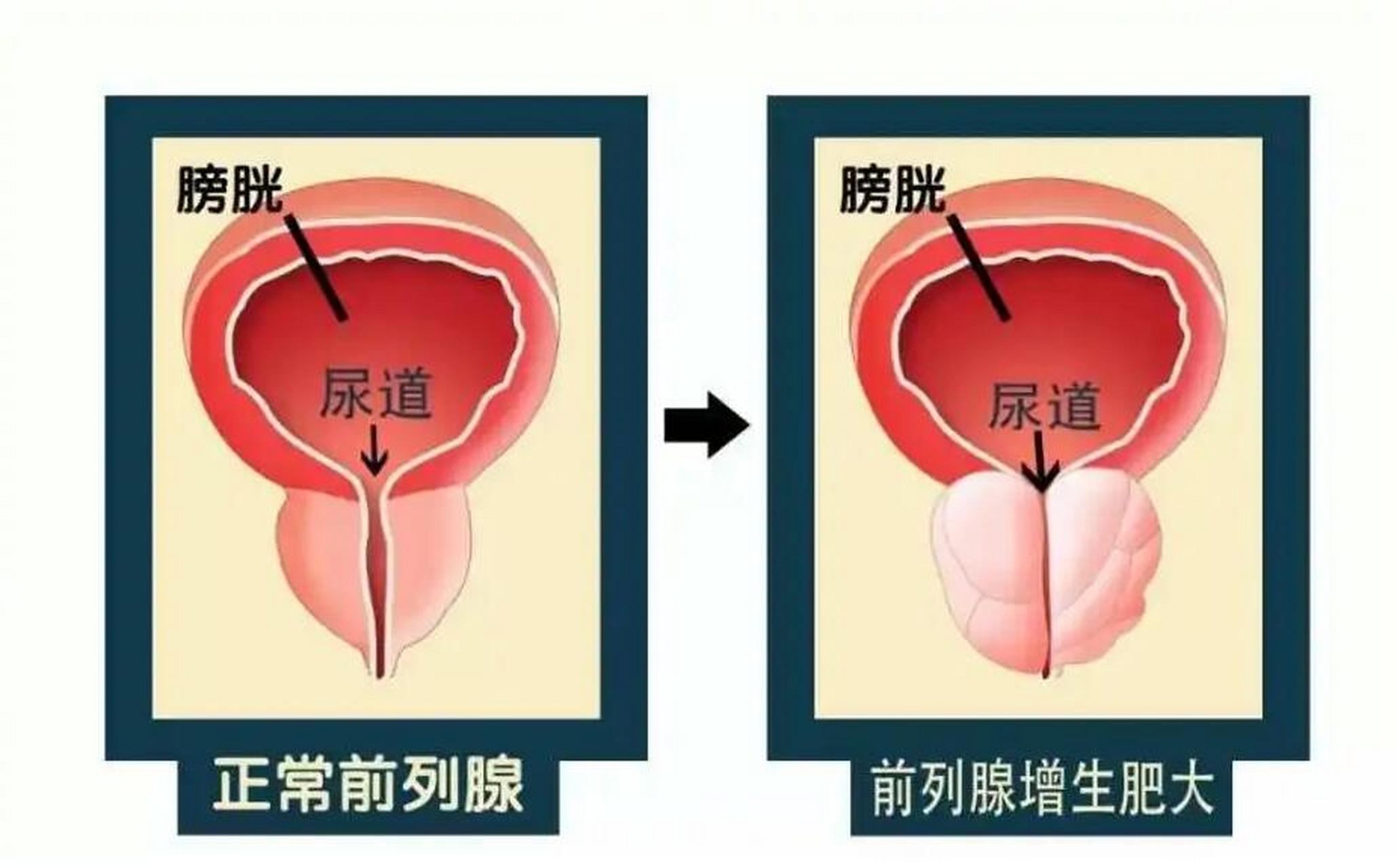 前列腺肥大图片原因图片