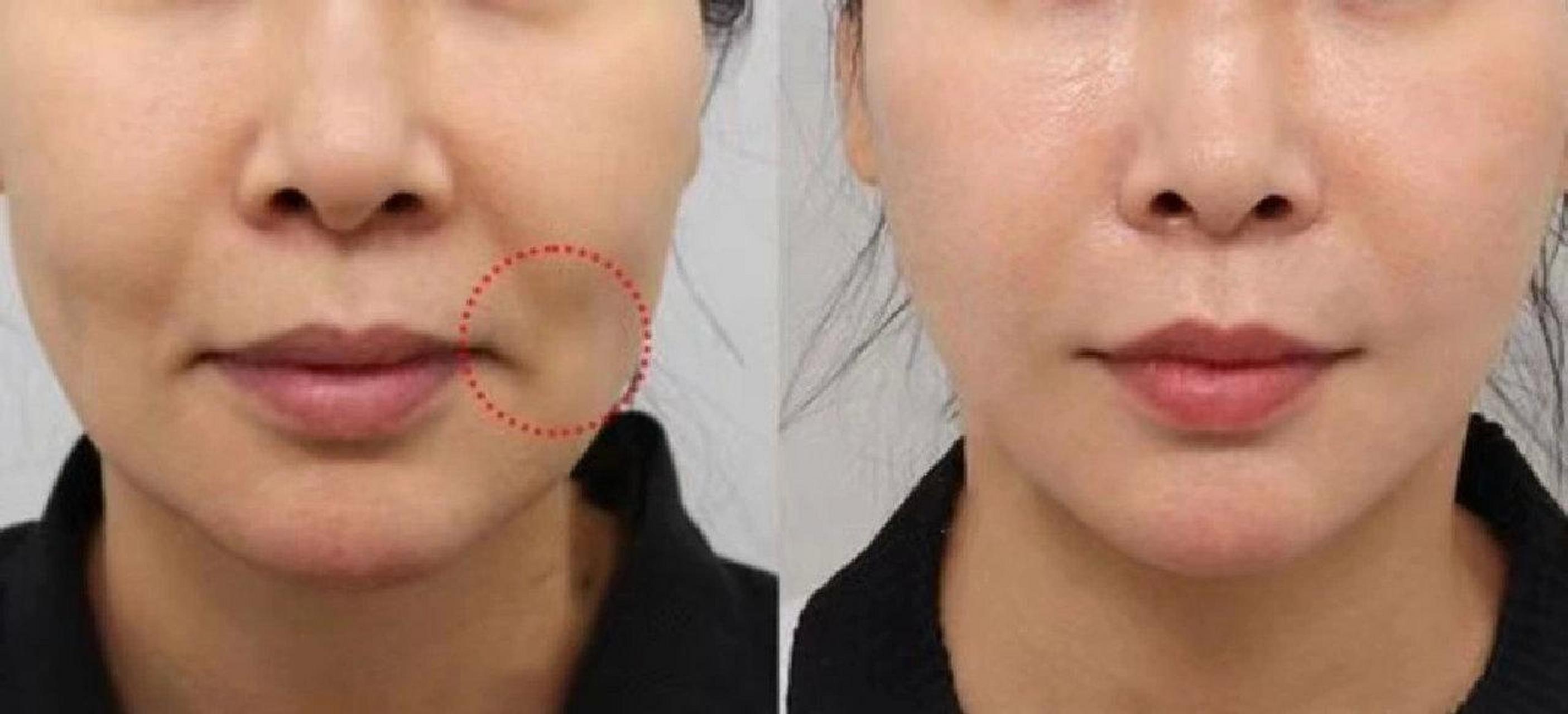 瘦脸 法令纹 口周纹一个月打卡我的脸上的肉捏起来有肉,能提起来的