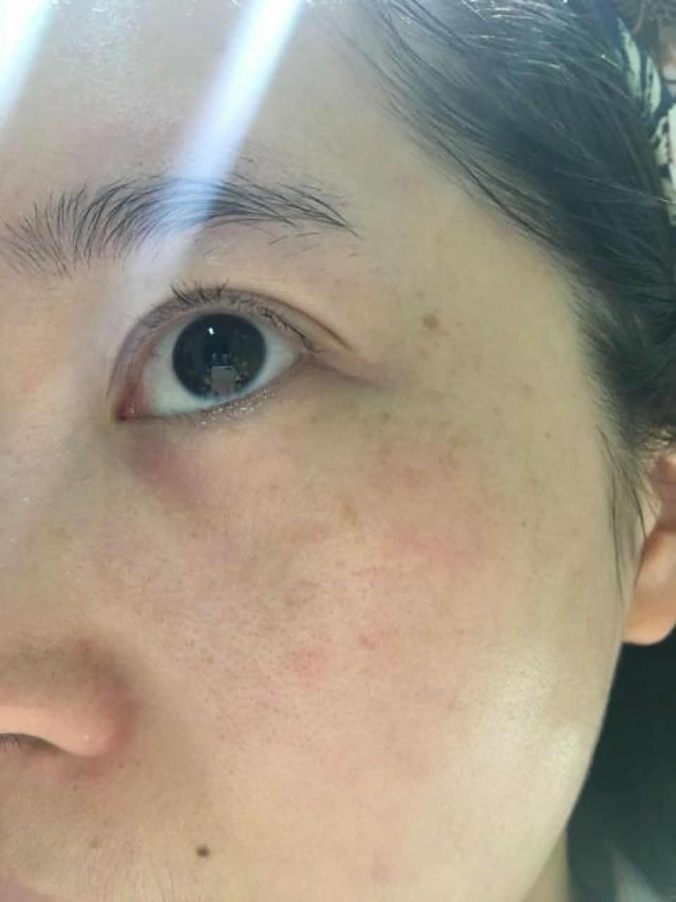 眼角长斑是指在眼睑或眼角周围出现的色素沉着或色素斑点.