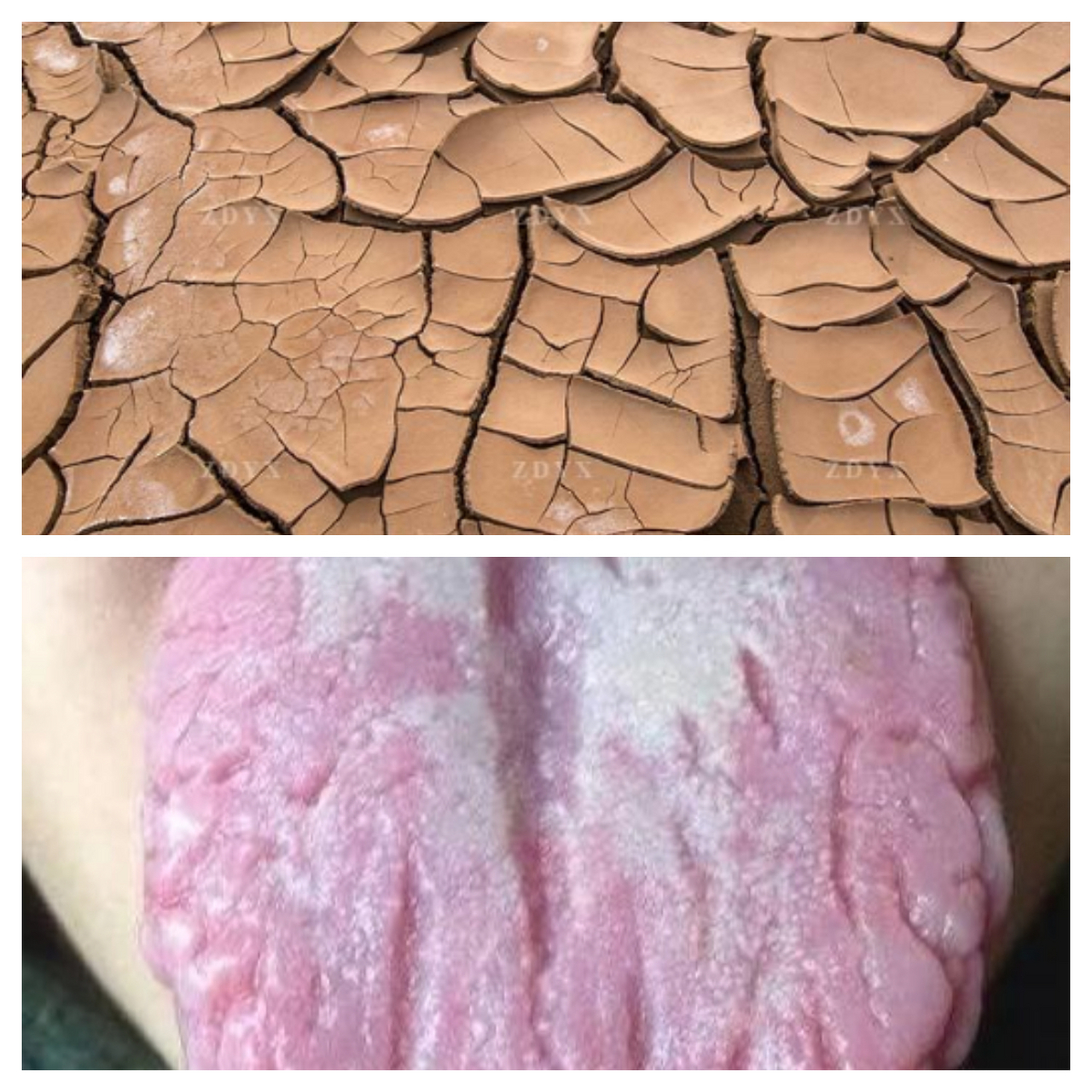 中医的思路辨证来帮助 看到很多朋友留言说要我讲讲舌头有裂纹怎么