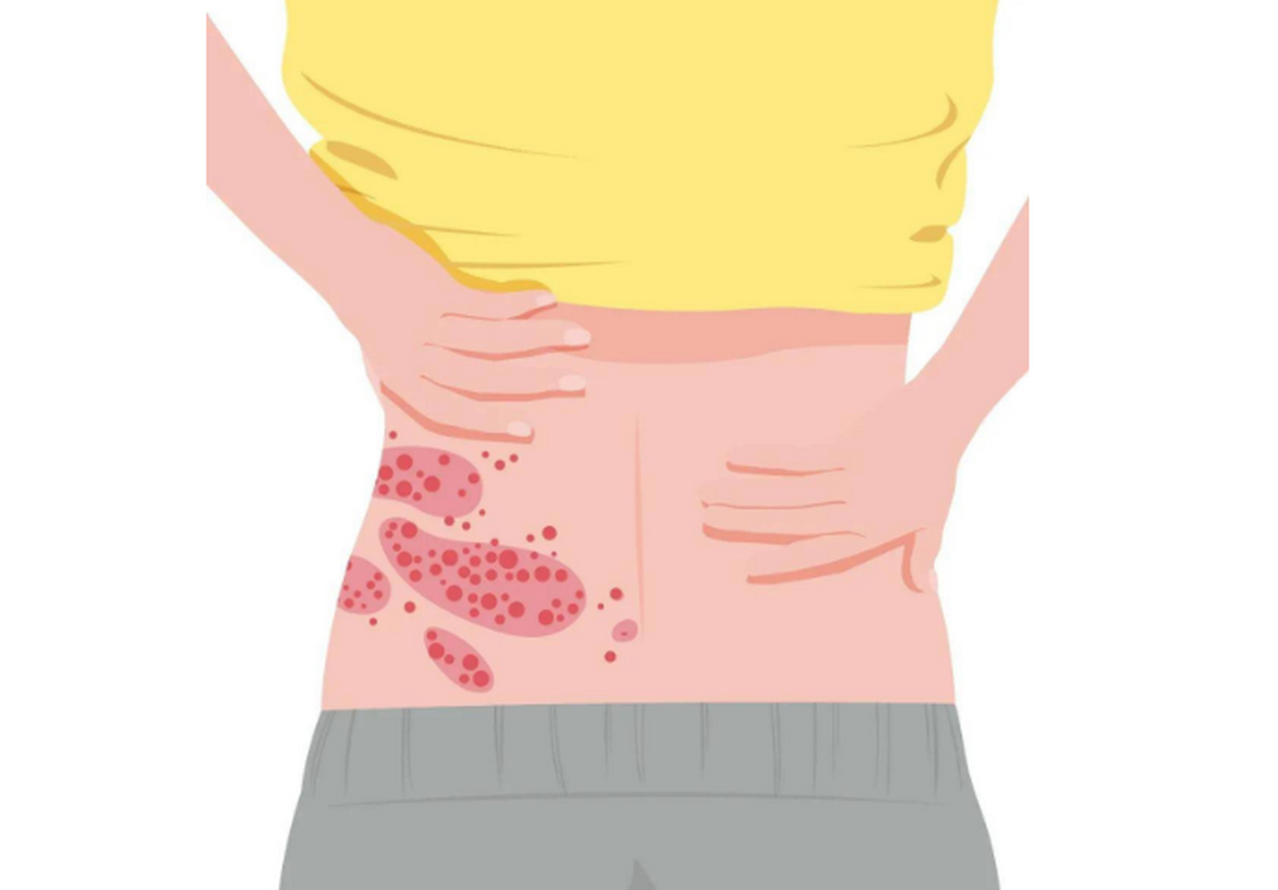 带状疱疹俗称"蛇盘疮",是由水痘-带状疱疹病毒引起的感染性疾病