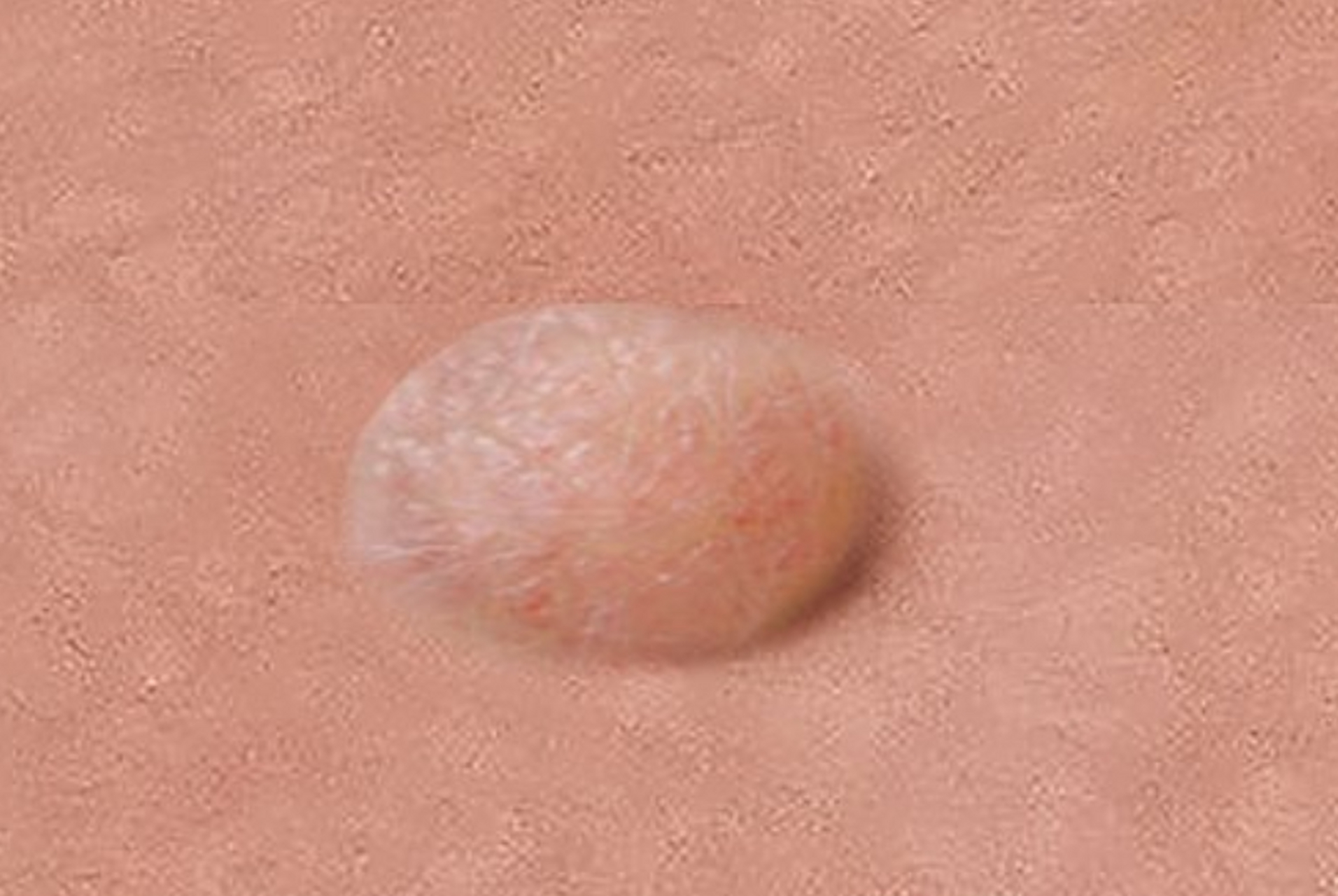 尖锐湿疣初期中期晚期  初期:尖锐湿疣通常表现为一些微小的,红色的