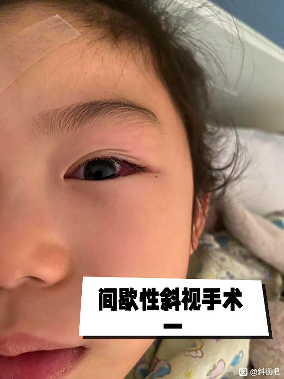 女儿7周岁不到3个月 间歇性斜视手术 一#疾病治疗经验# #健康经验笔记