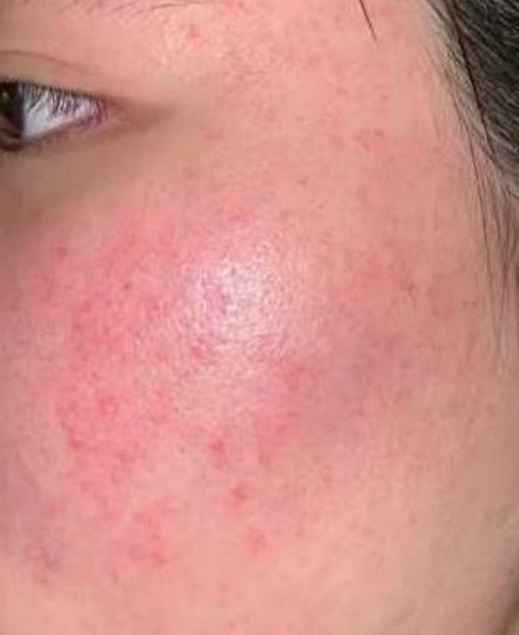 但与痘痘不同的是,玫瑰痤疮不会长出白头,而且容易发生在脸颊,鼻子