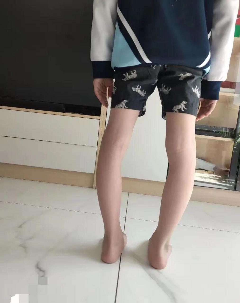 o型腿长成这样,连手术都困难了,而且还有足外翻,两者互相纠正,矫形