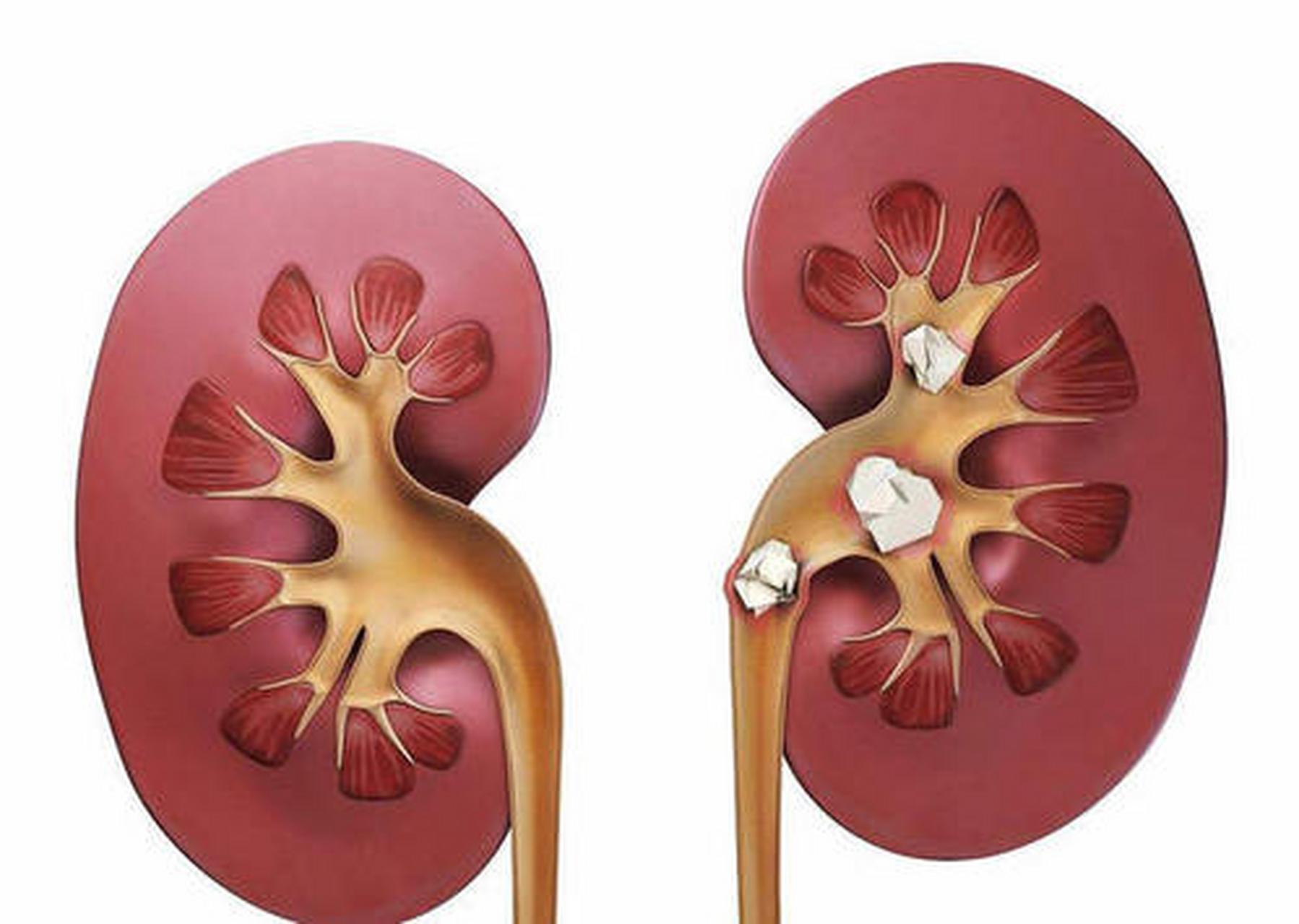 肾结石长在肾脏的肾盂,肾盏里,也就是储存原尿的地方.