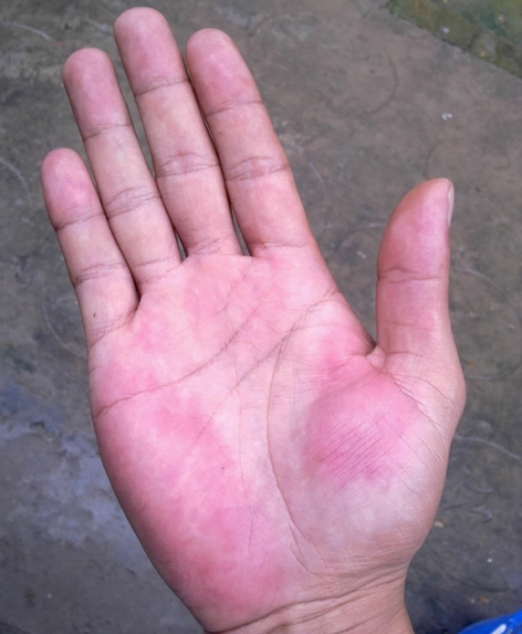 陈先生39岁,三个月前他发现自己的手掌老是红,还有点发热,尤其是大