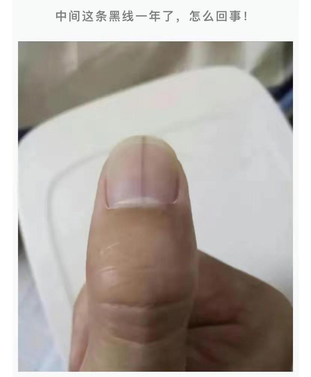 网友:指甲中间有条黑线,怎么回事?