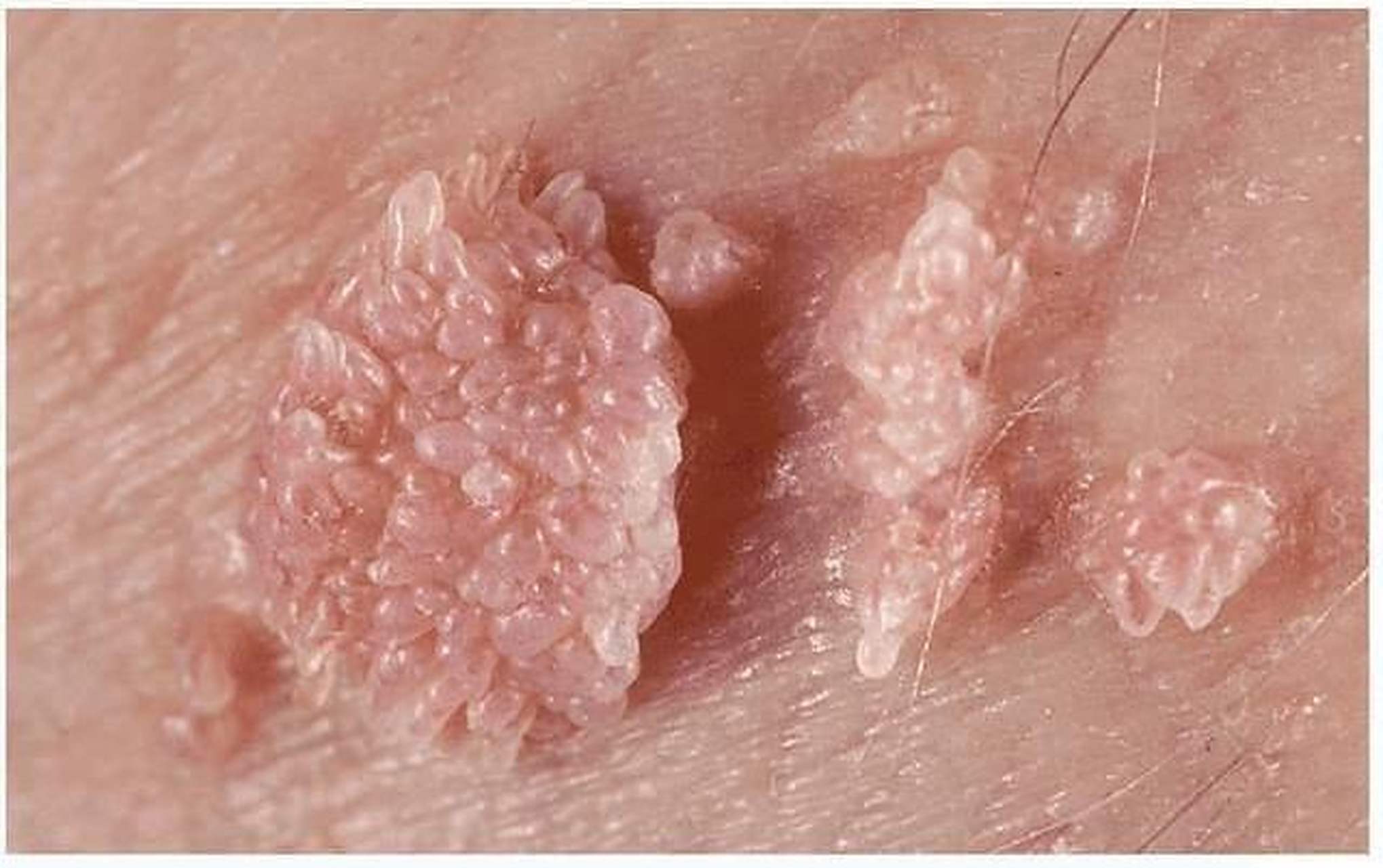 尖锐湿疣,它其实主要是长在男性的包皮,阴茎或者女性的外阴,阴道