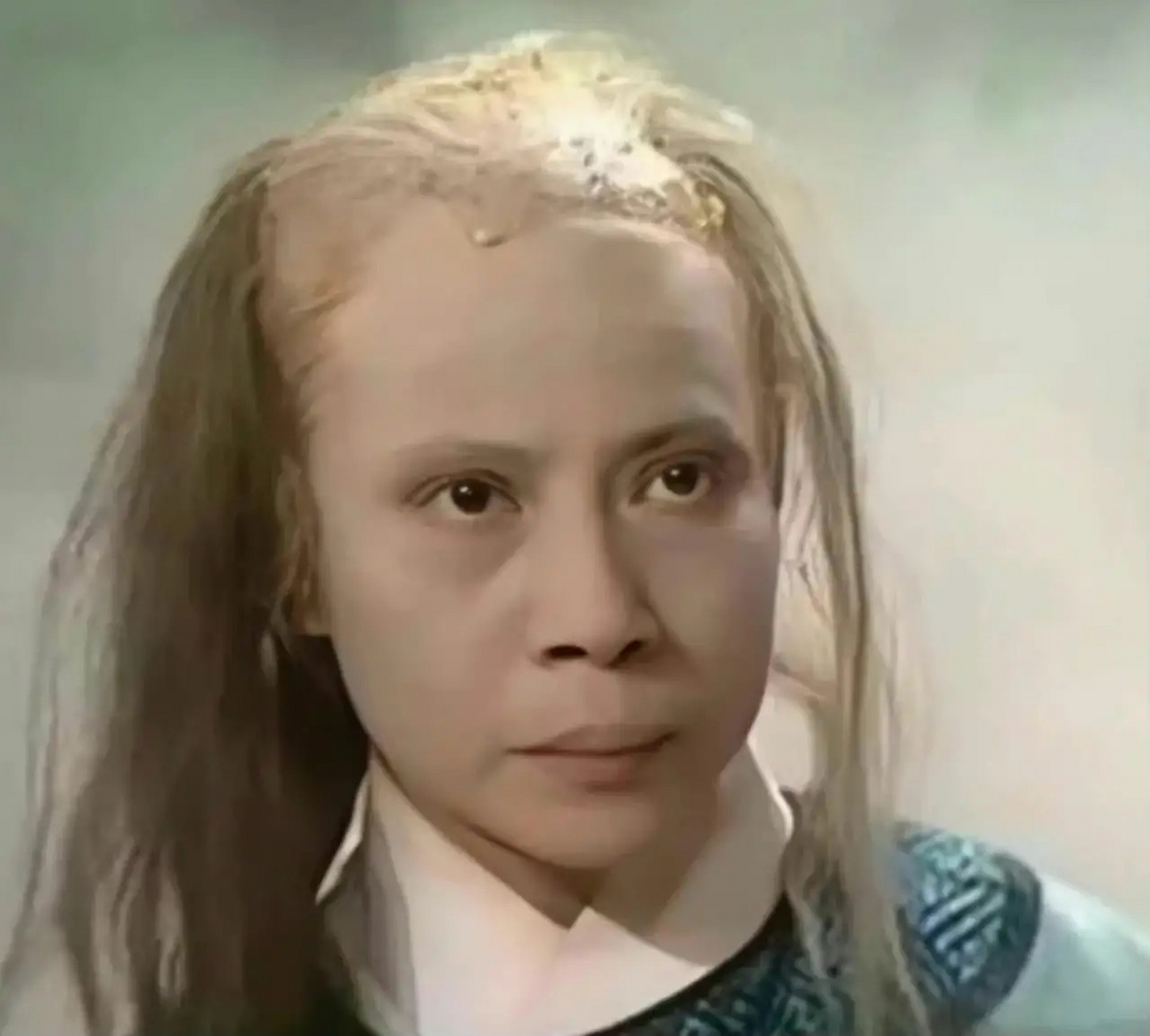 发际线越来越高,额头大面积脱发,这是怎么了?
