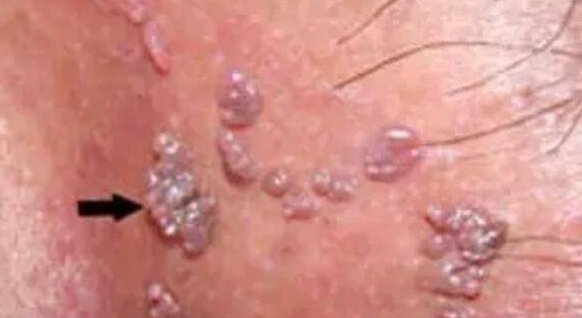 结果在网上查了一下,发现自己可能感染了hpv!