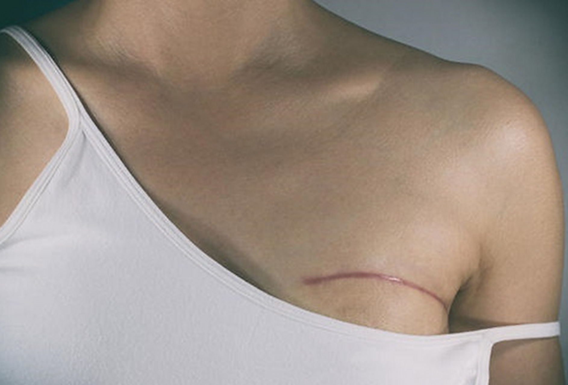 "我老婆才32岁,上个月发现乳房有硬块,做了钼靶,穿刺,确诊是乳腺癌.