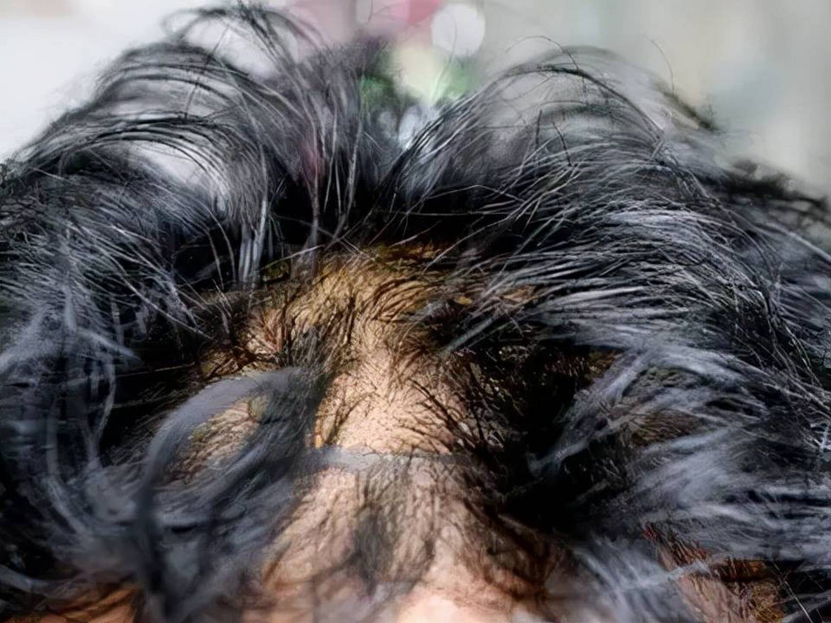 夏季头皮油,头屑多,不及时洗头,就会造成头皮油脂堆积,头上出现一些