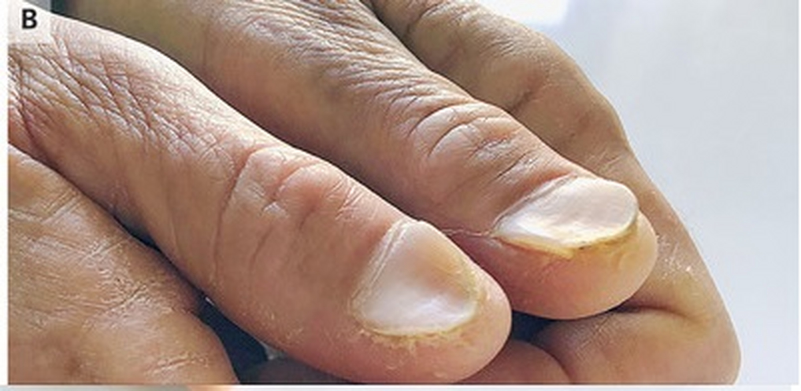 缺铁性贫血中的匙状甲:一位54岁的妇女因疲劳和7年间歇性痔疮出血病史