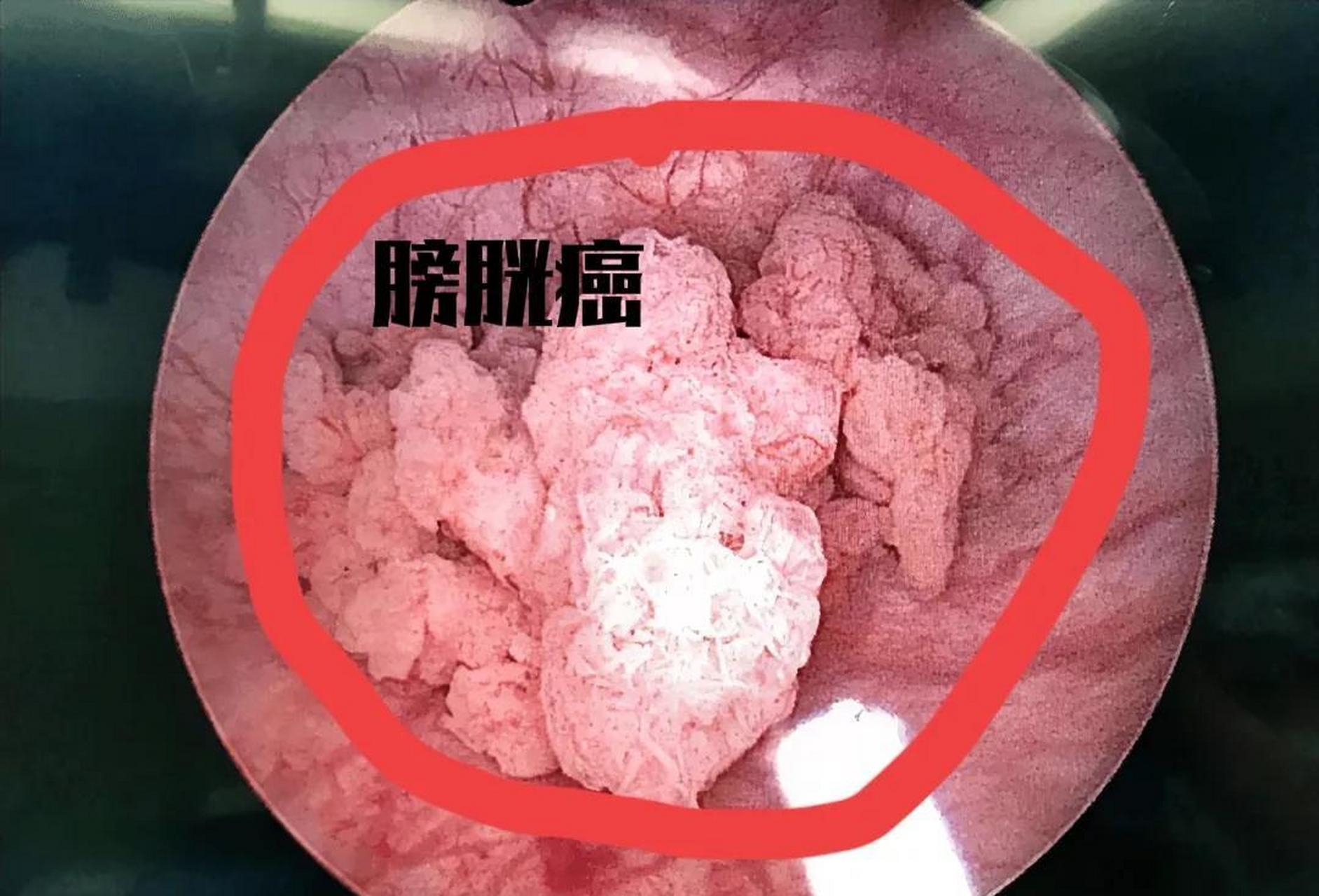 膀胱癌一般向膀胱腔内生长,刚开始扎根不深,我们可以通过电切手术把长