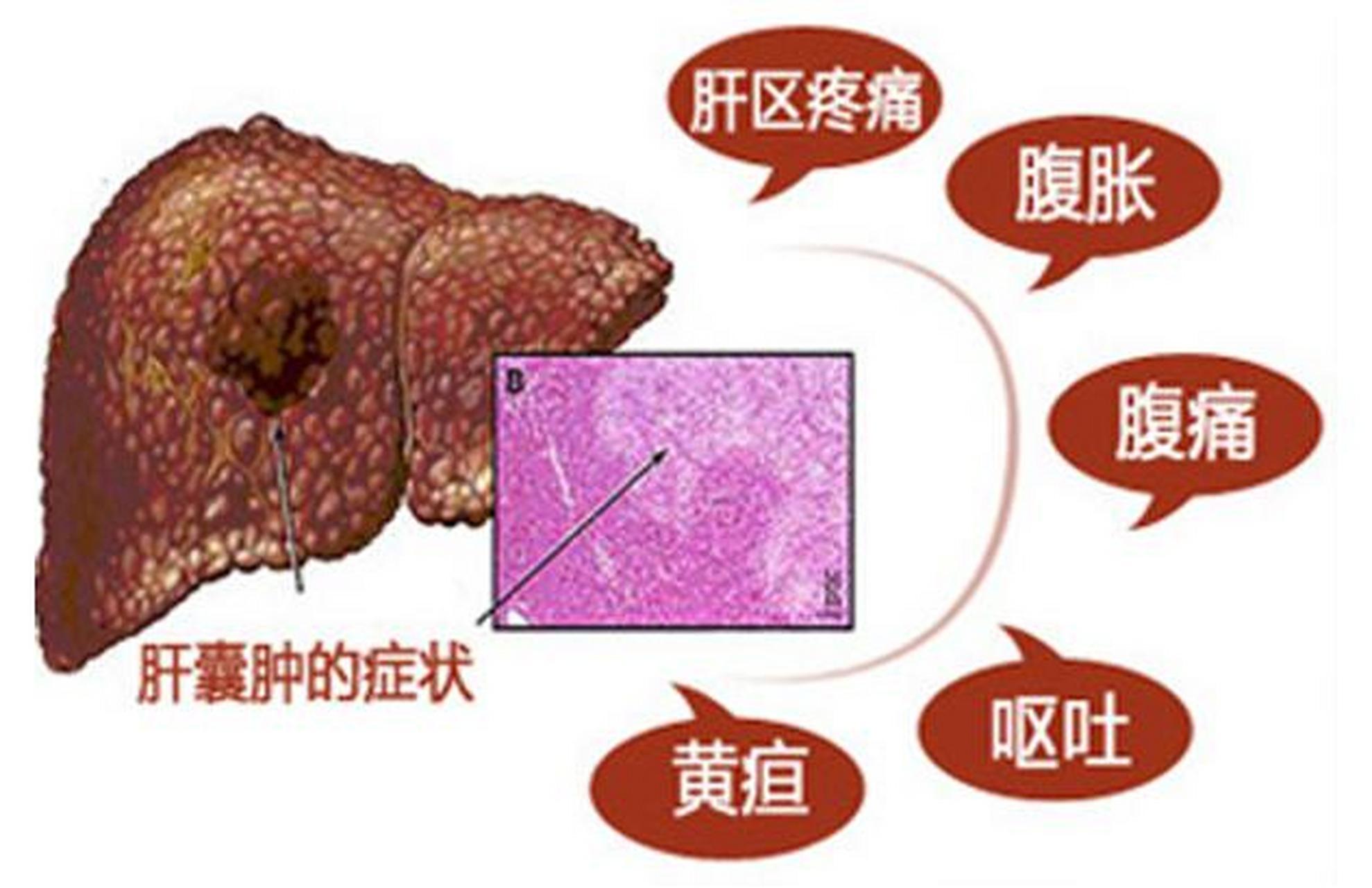 肝包膜图片图片